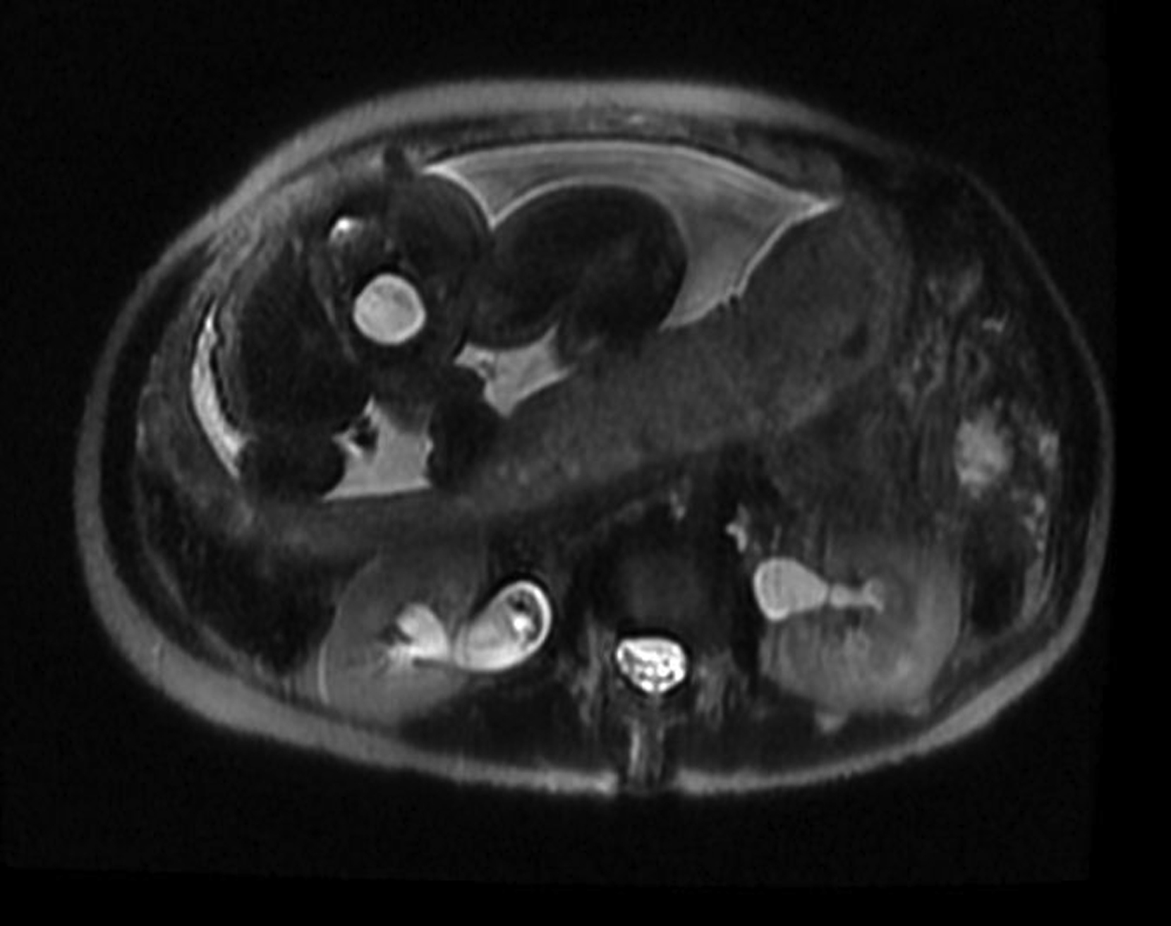 Fig. 23.1, Maternal hydronephrosis.