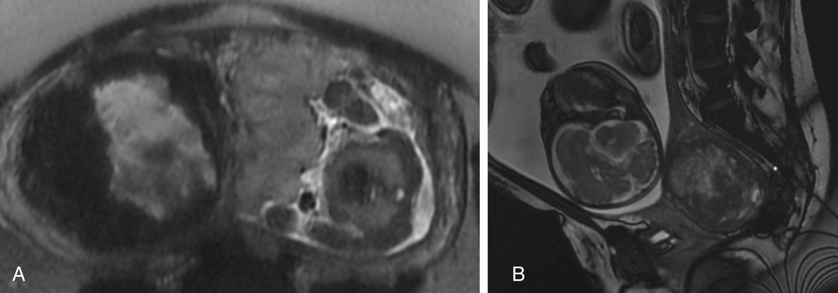 Fig. 23.2, Fibroids.