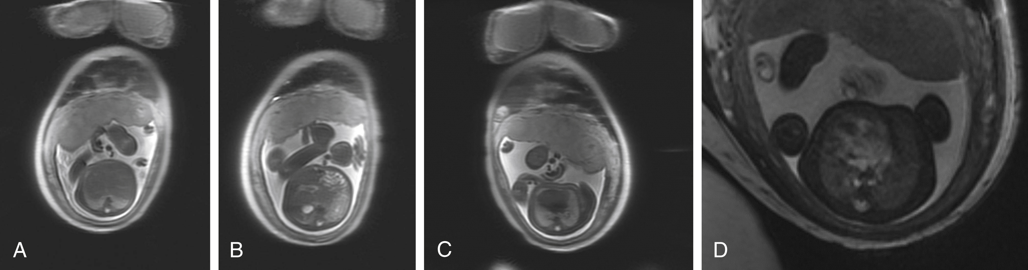 Fig. 23.4, Heterotaxy, 26-week fetus.
