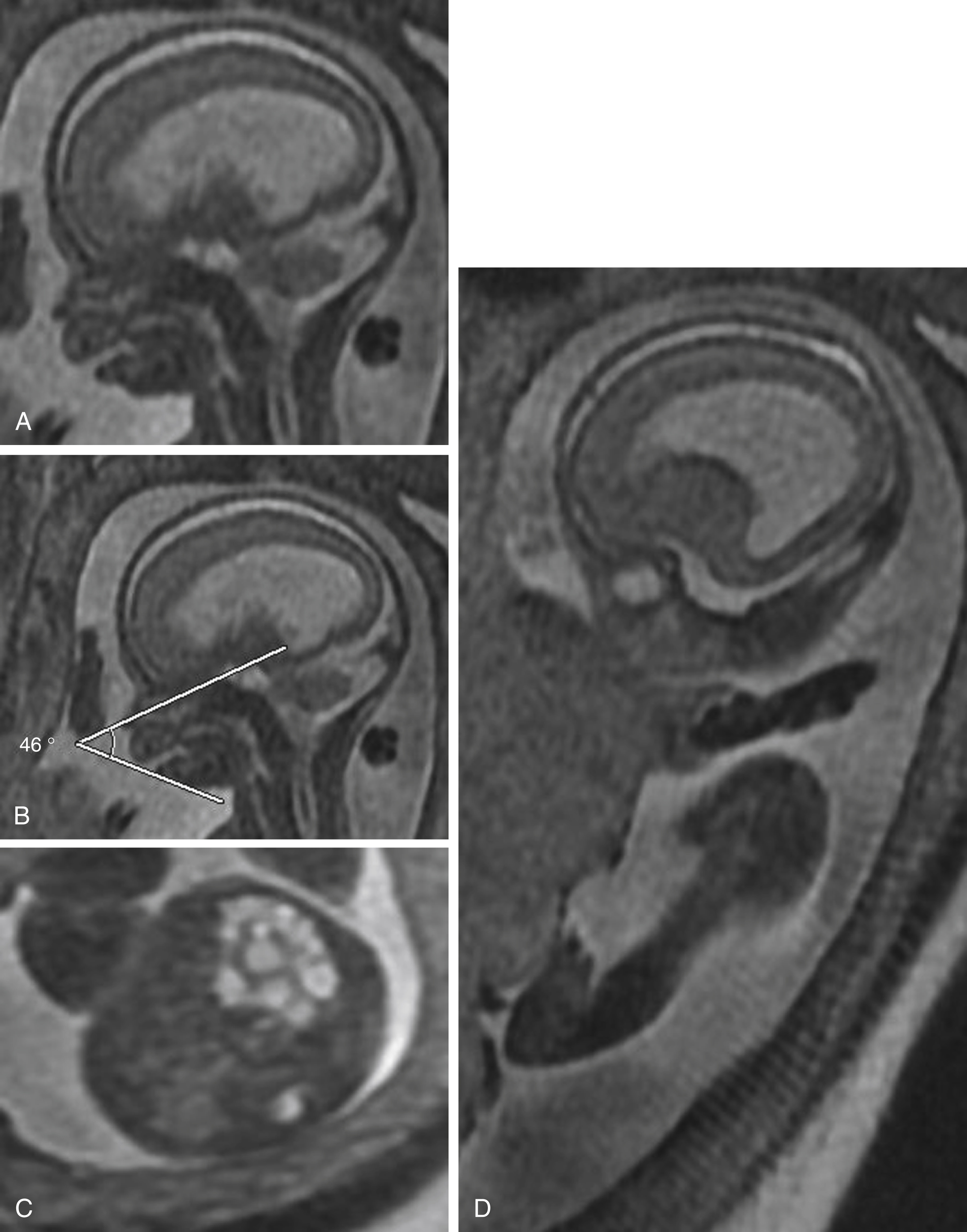 Fig. 23.7, Micrognathia, 21-week fetus.