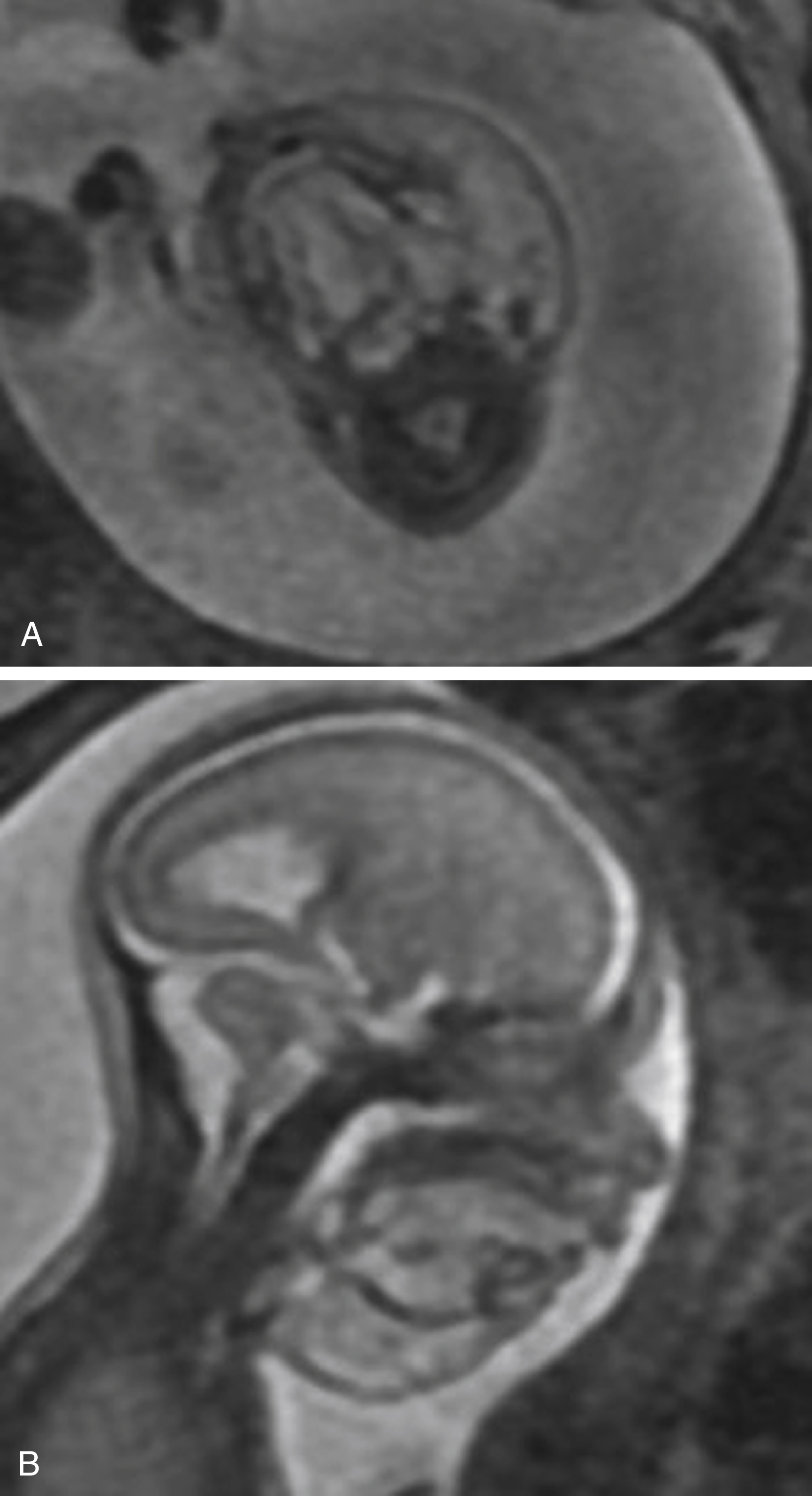 Fig. 23.8, Lymphatic malformation, 22-week fetus.