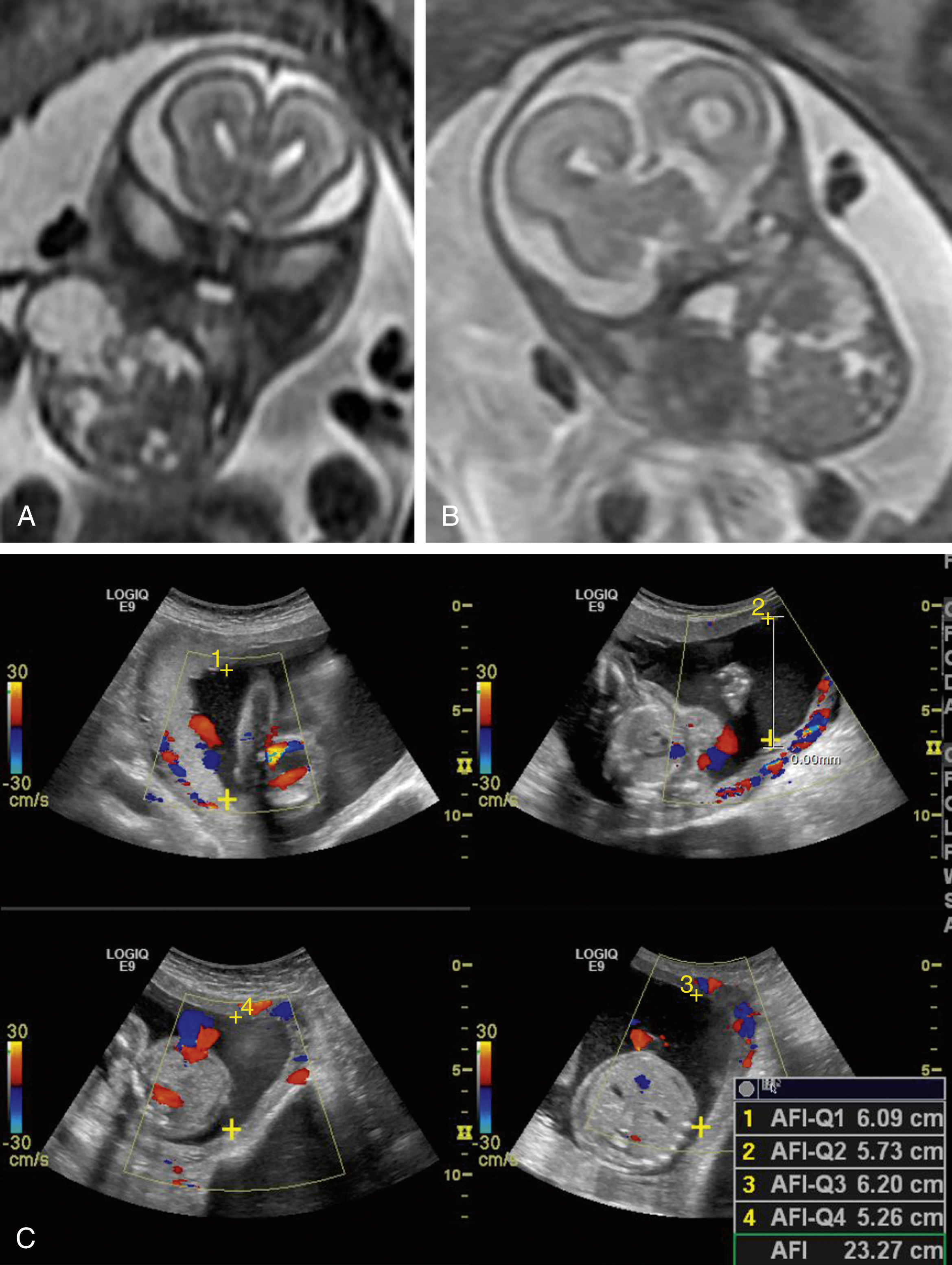 Fig. 23.9, Cervical teratoma, 20-week fetus.