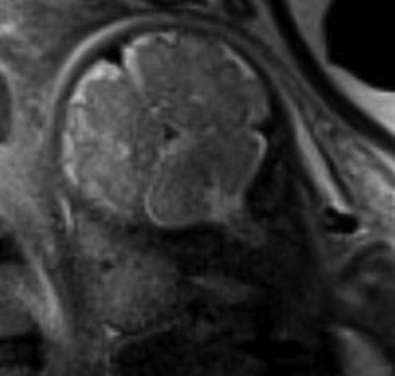 Fig. 23.10, Congenital hemangioma.