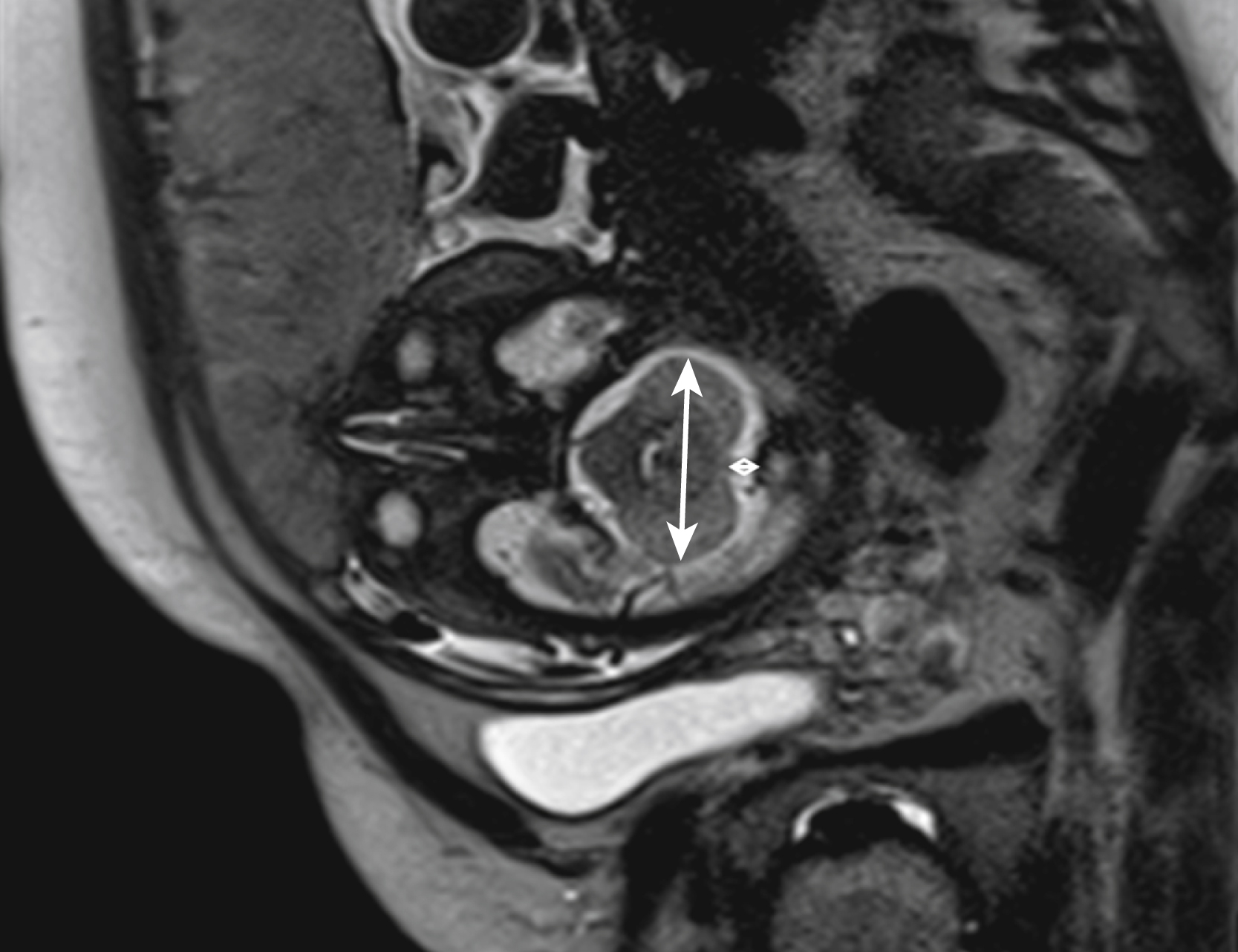 Fig. 24.1, Transverse cerebellar dimension (TCD) and cisterna magna (CM).