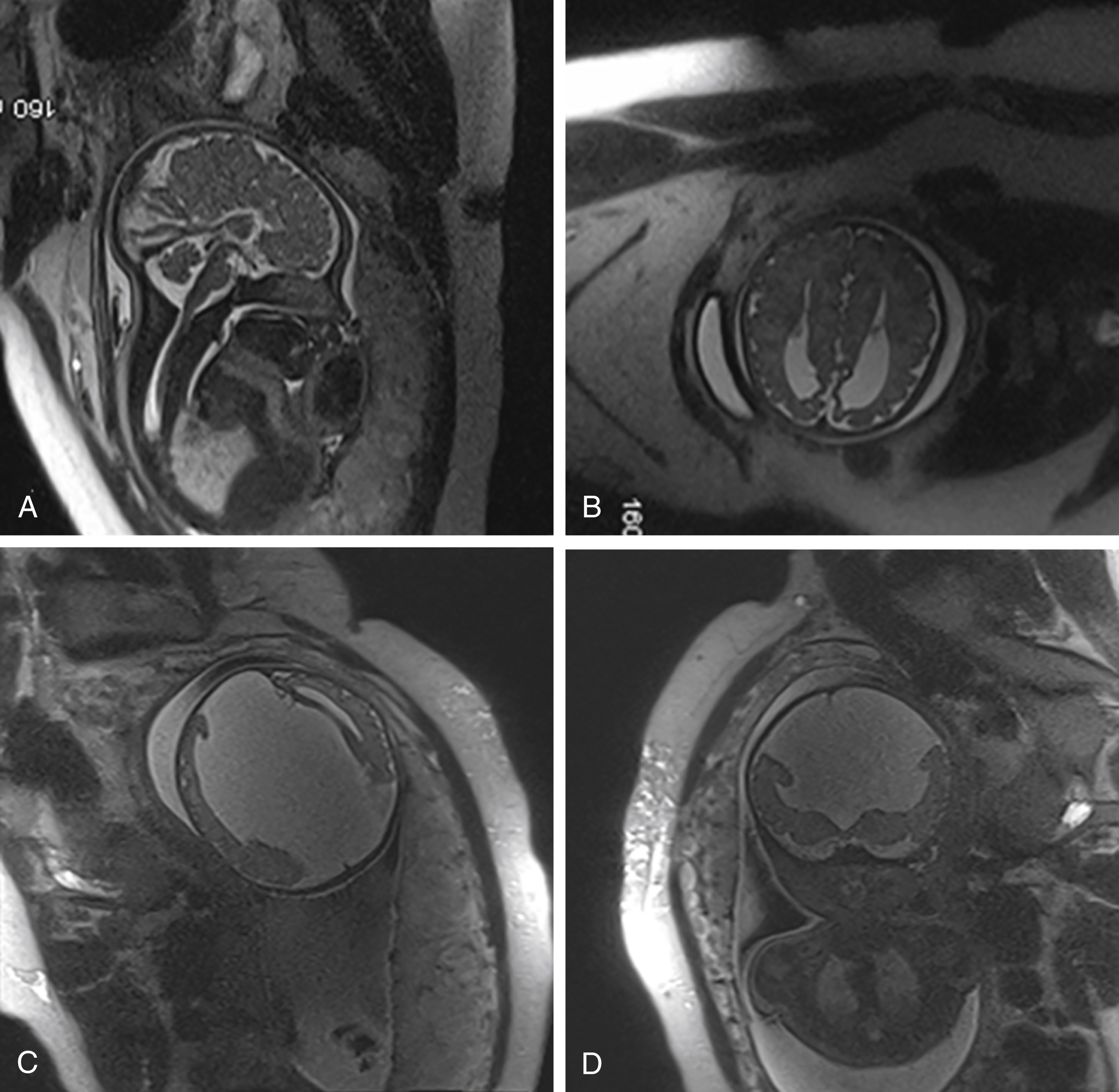 Fig. 24.4, Agenesis of the corpus callosum (ACC).