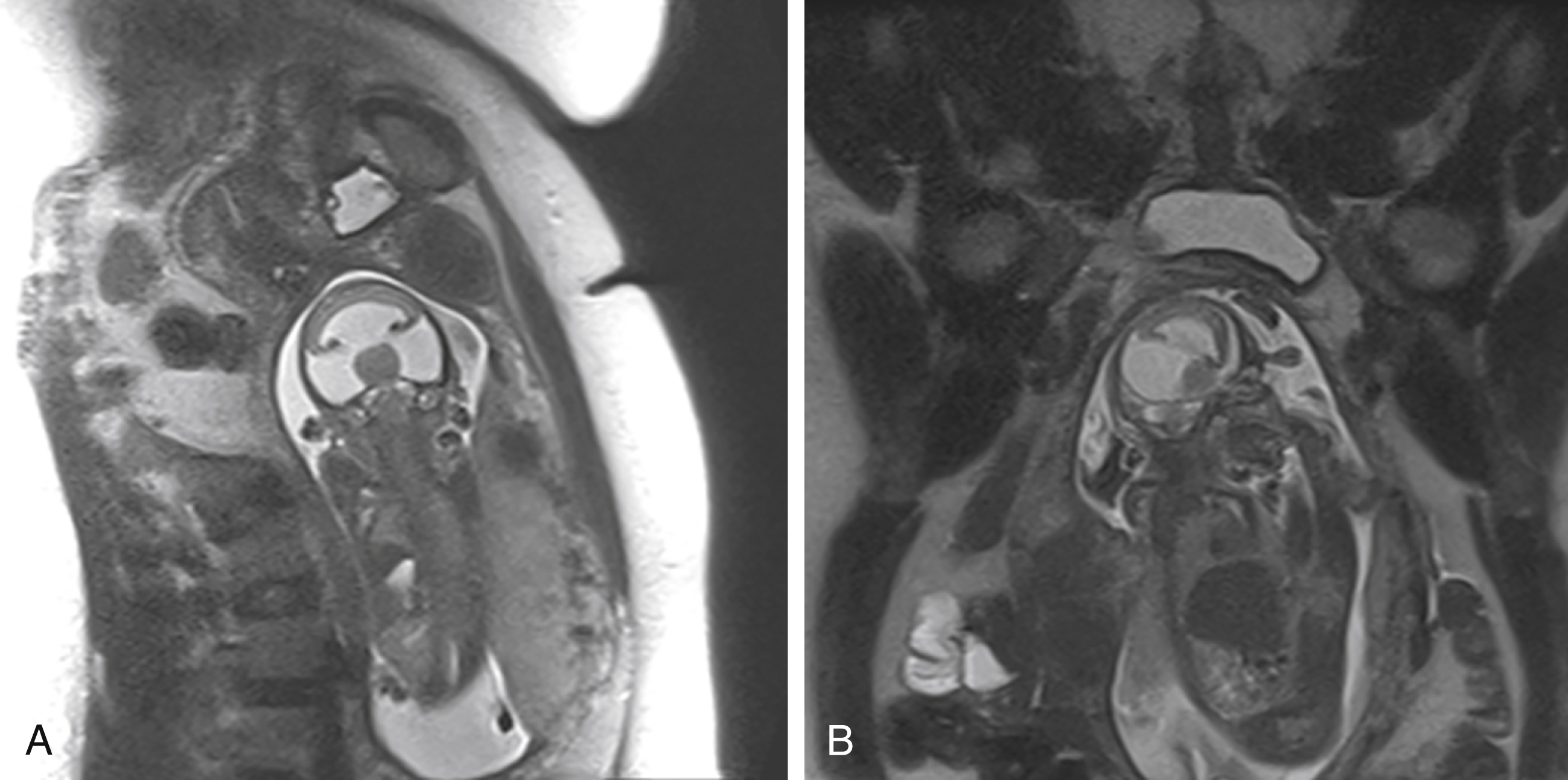 Fig. 24.5, Lobar holoprosencephaly.