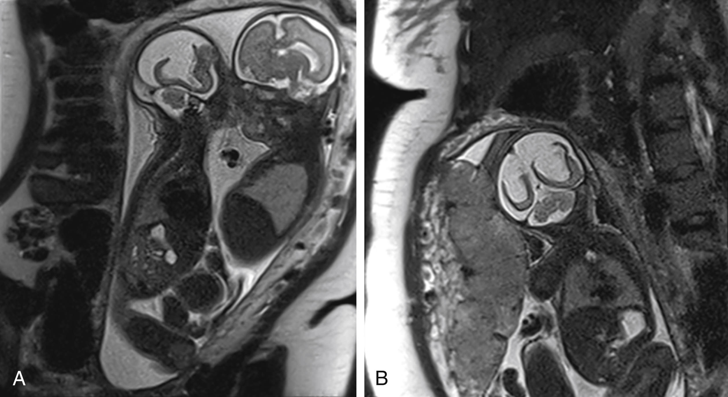 Fig. 24.6, Porencephaly.