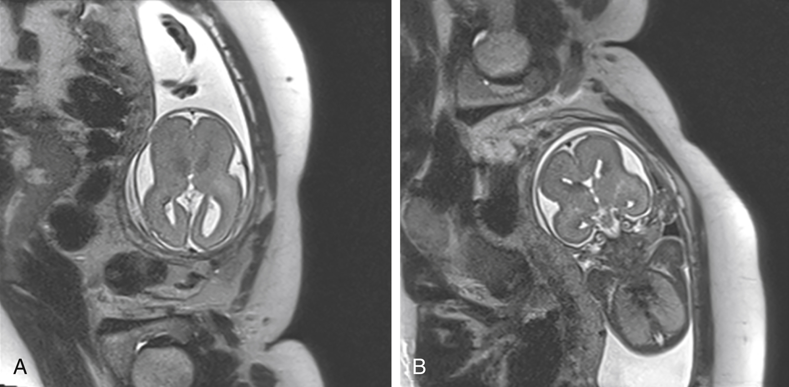 Fig. 24.8, Cortical dysplasia.