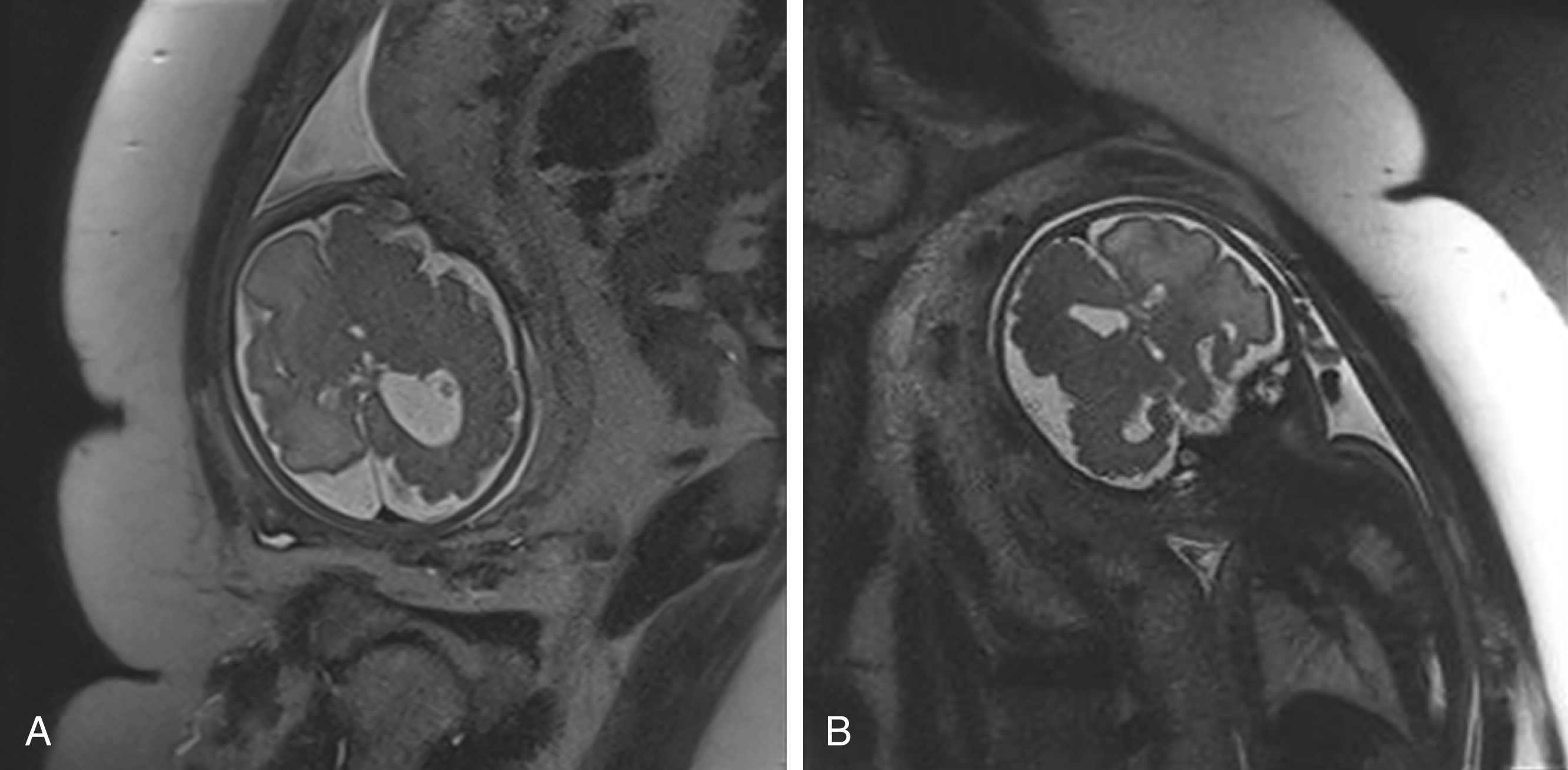 Fig. 24.9, Hemimegalencephaly.