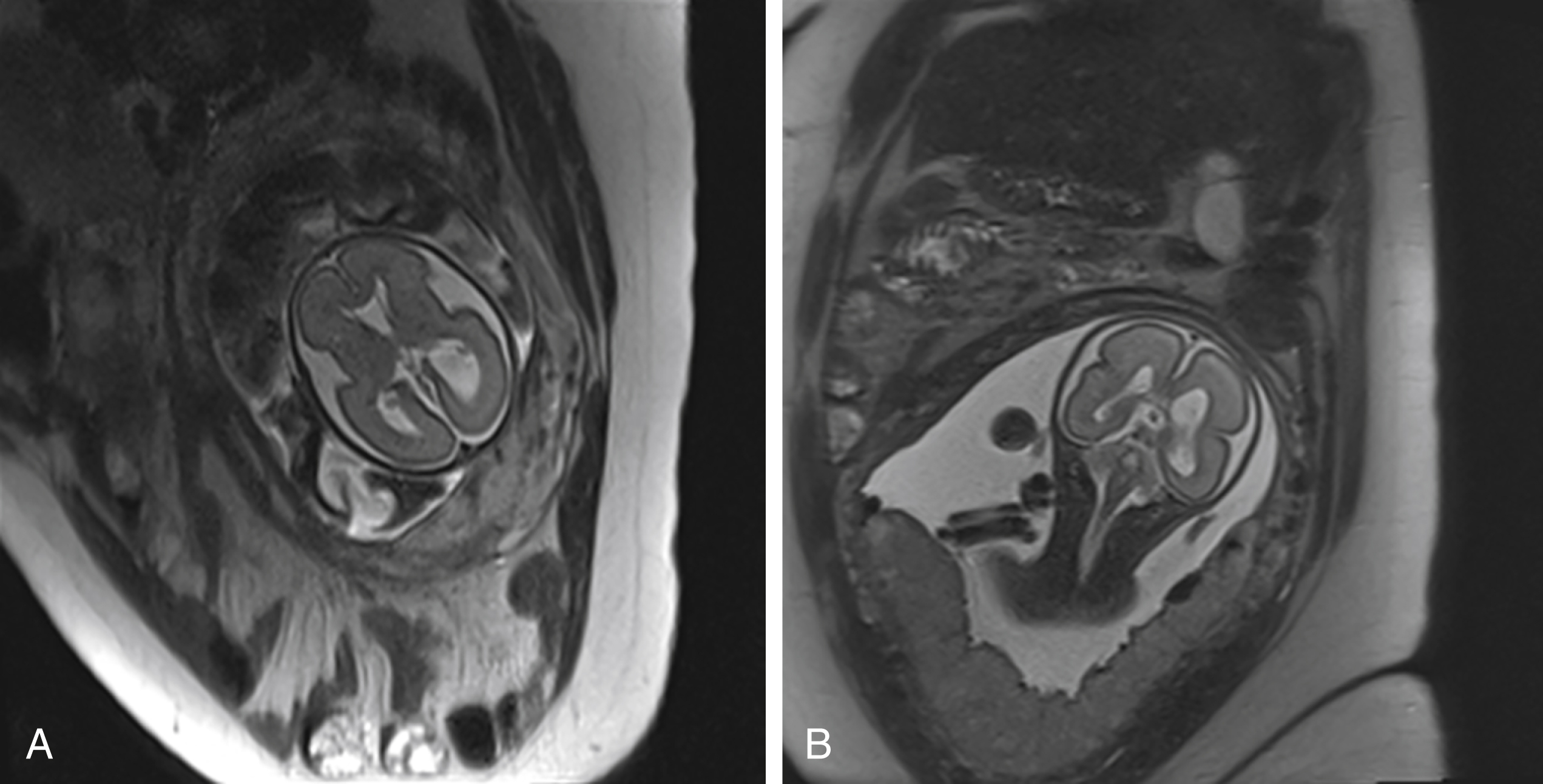 Fig. 24.10, Unilateral isolated ventriculomegaly (A-B).