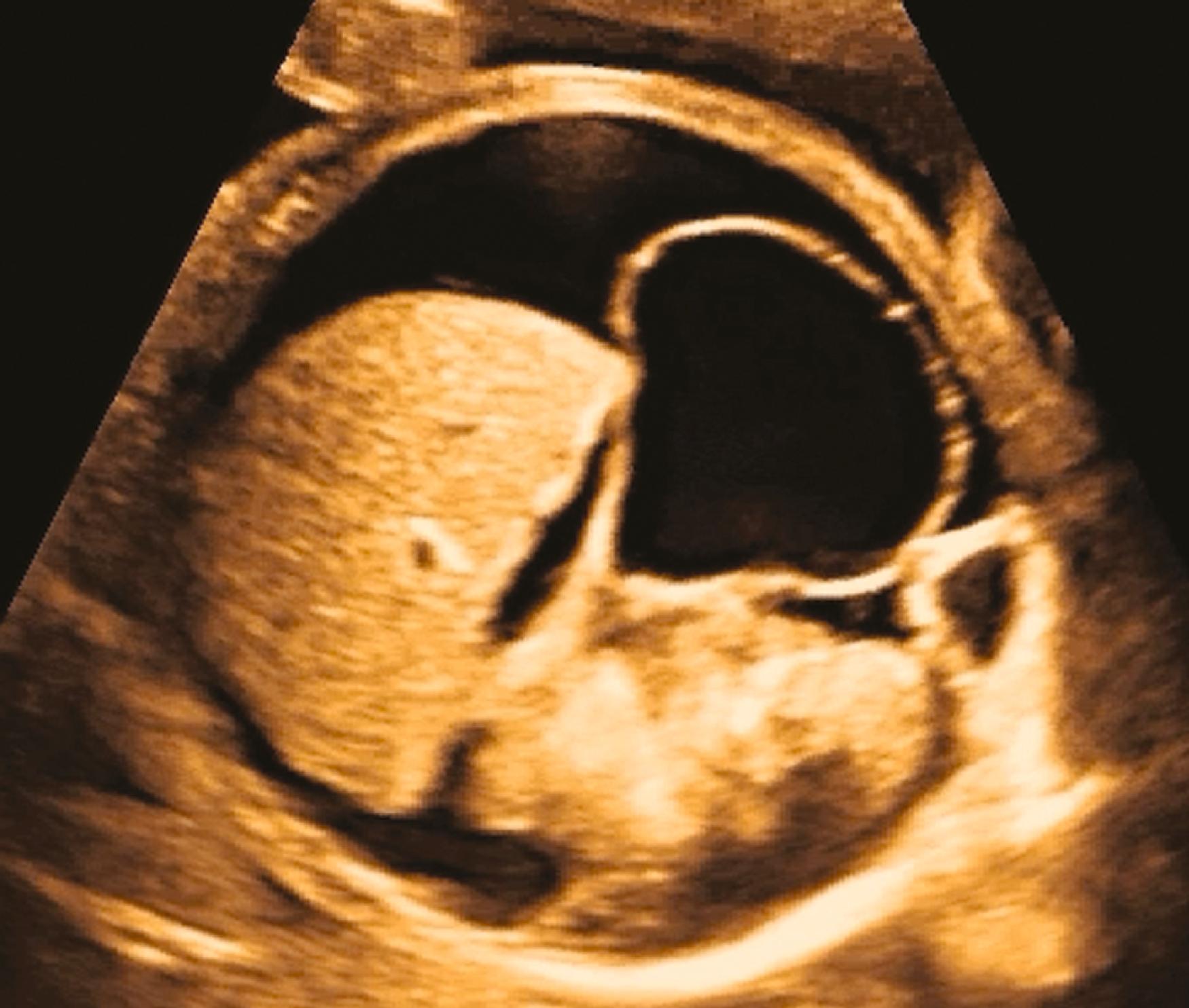 Figure 23.1, Transverse image of the fetal abdomen demonstrating marked ascites.