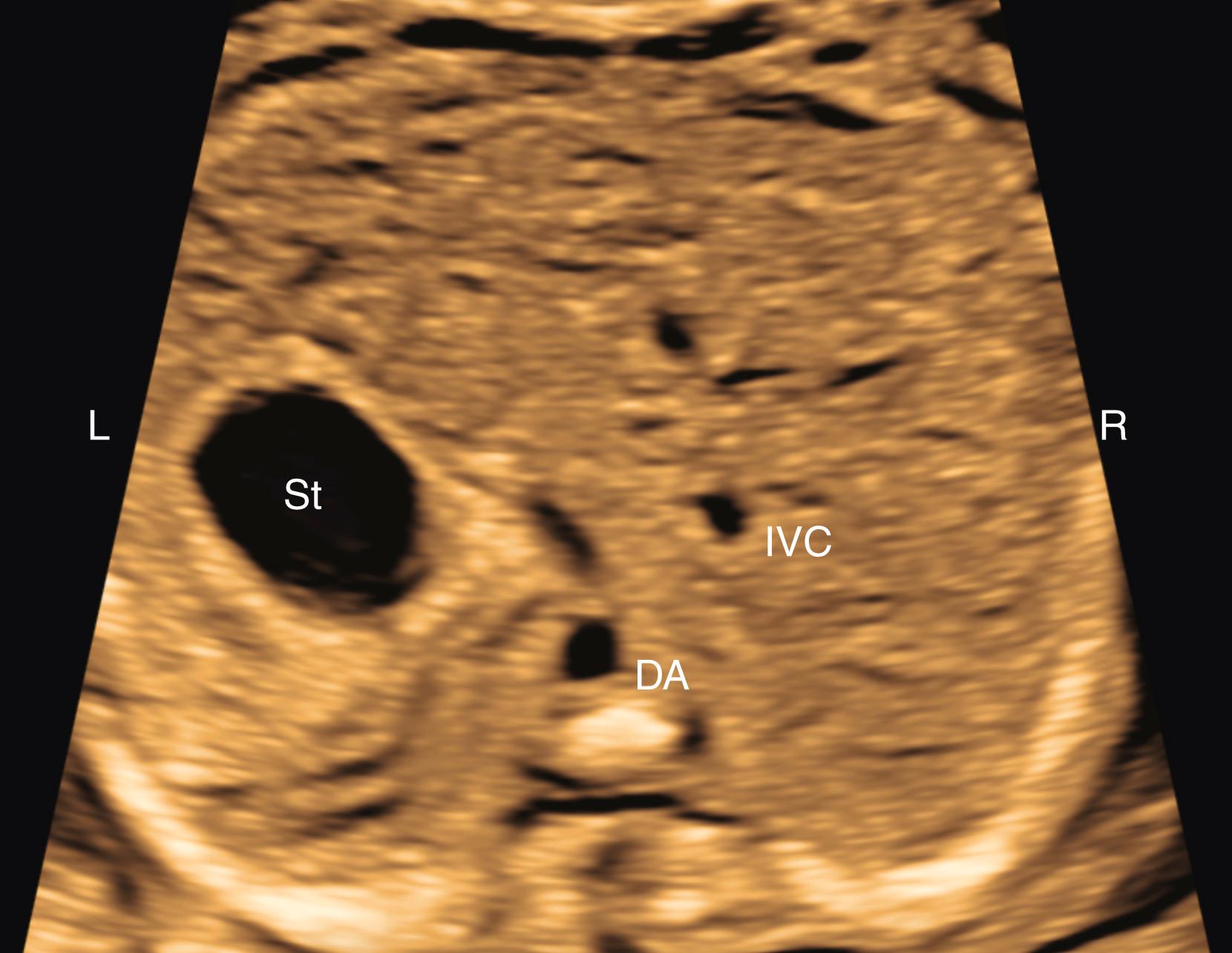 Figure 23.12, Fetal echocardiographic image of abdominal situs view.