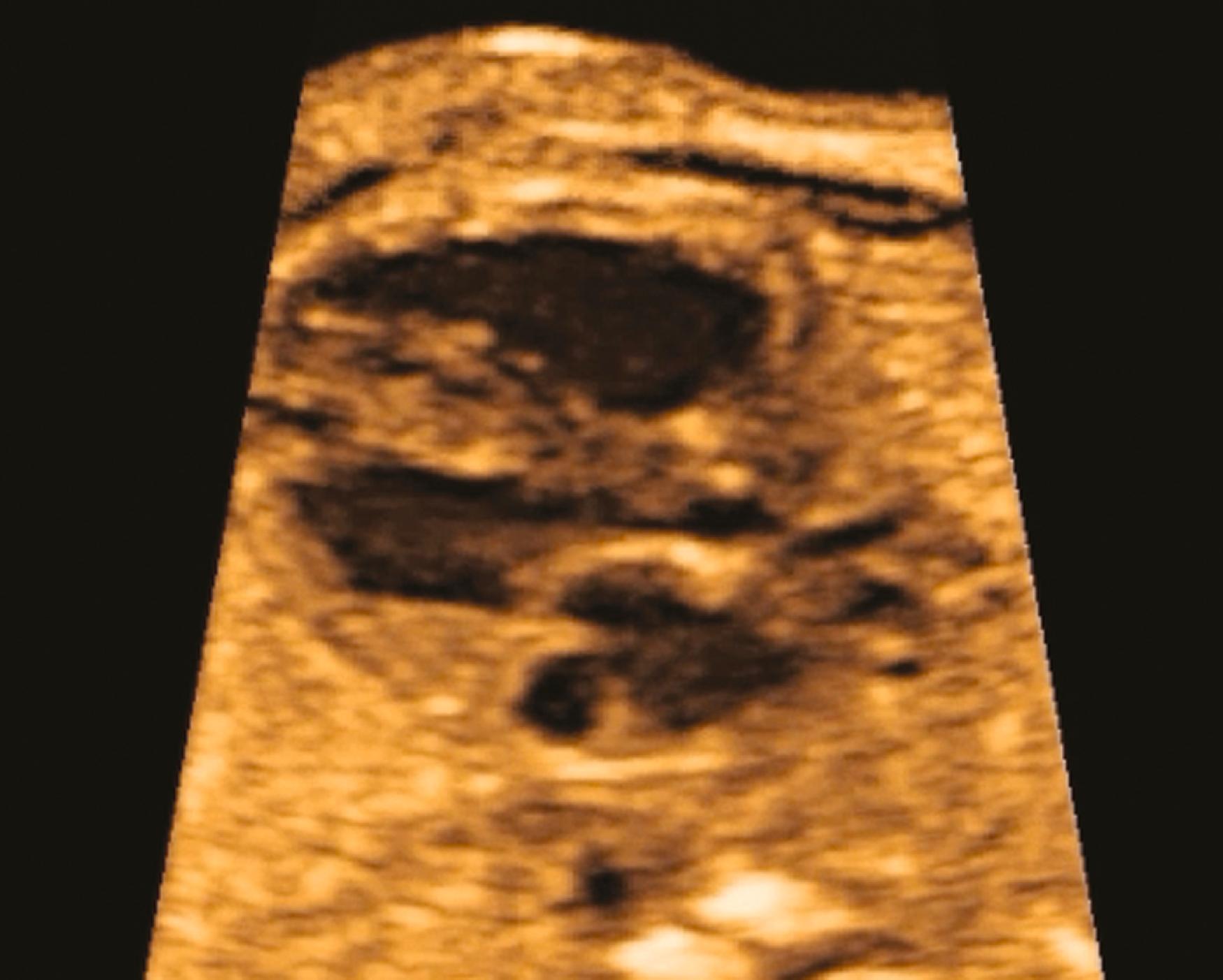 Figure 23.15, Fetal echocardiographic image of a left-ventricular long-axis view.