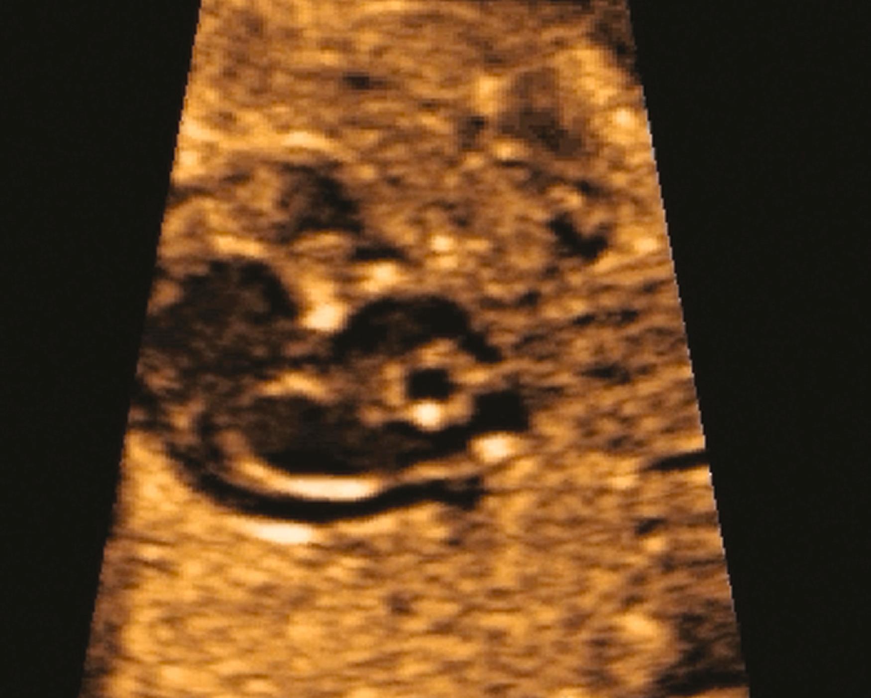 Figure 23.16, Sagittal image of the fetal thorax and heart demonstrating a left-sided superior vena cava draining posteriorly into the coronary sinus.
