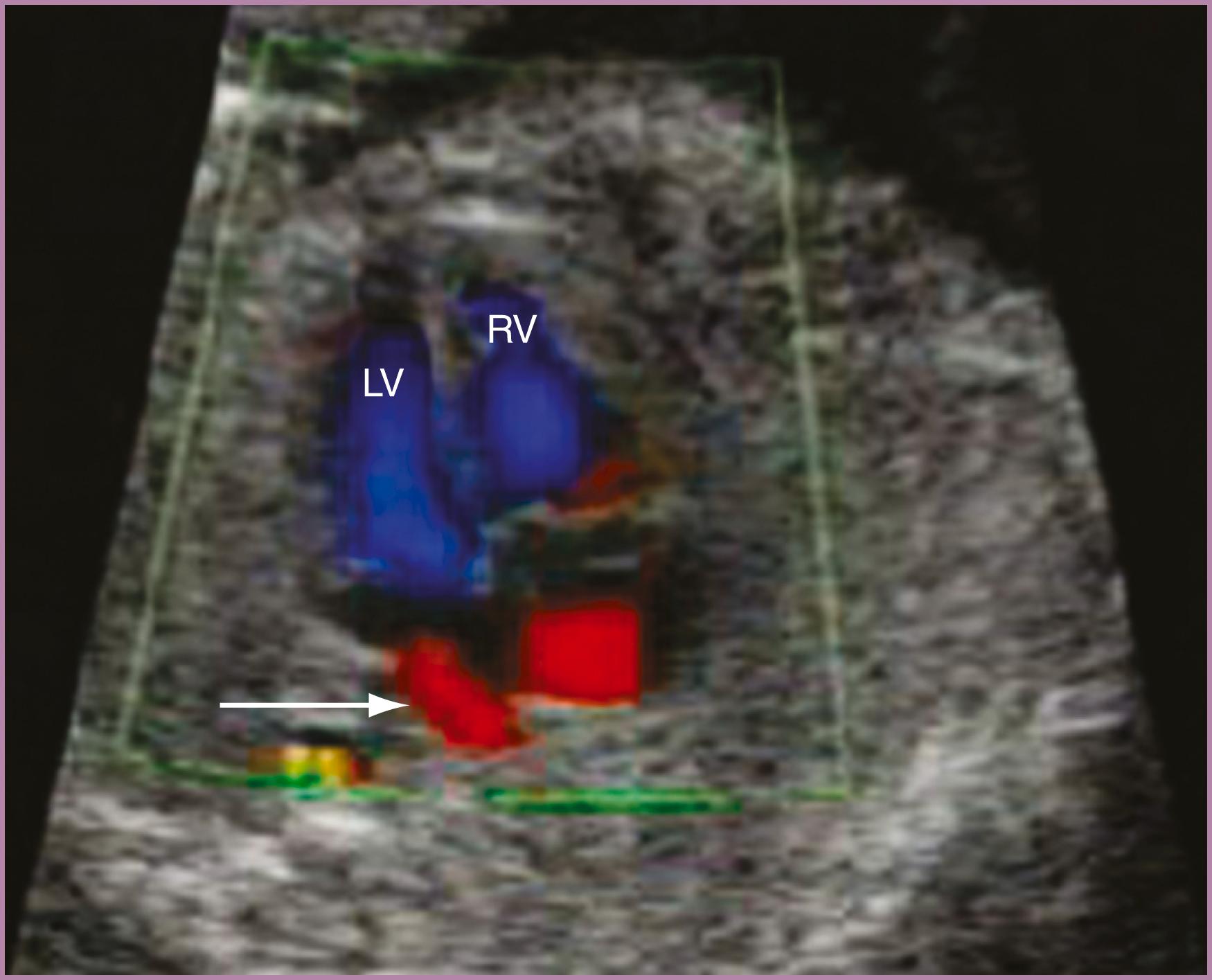 Figure 23.17, Fetal echocardiographic image of four-chamber view.