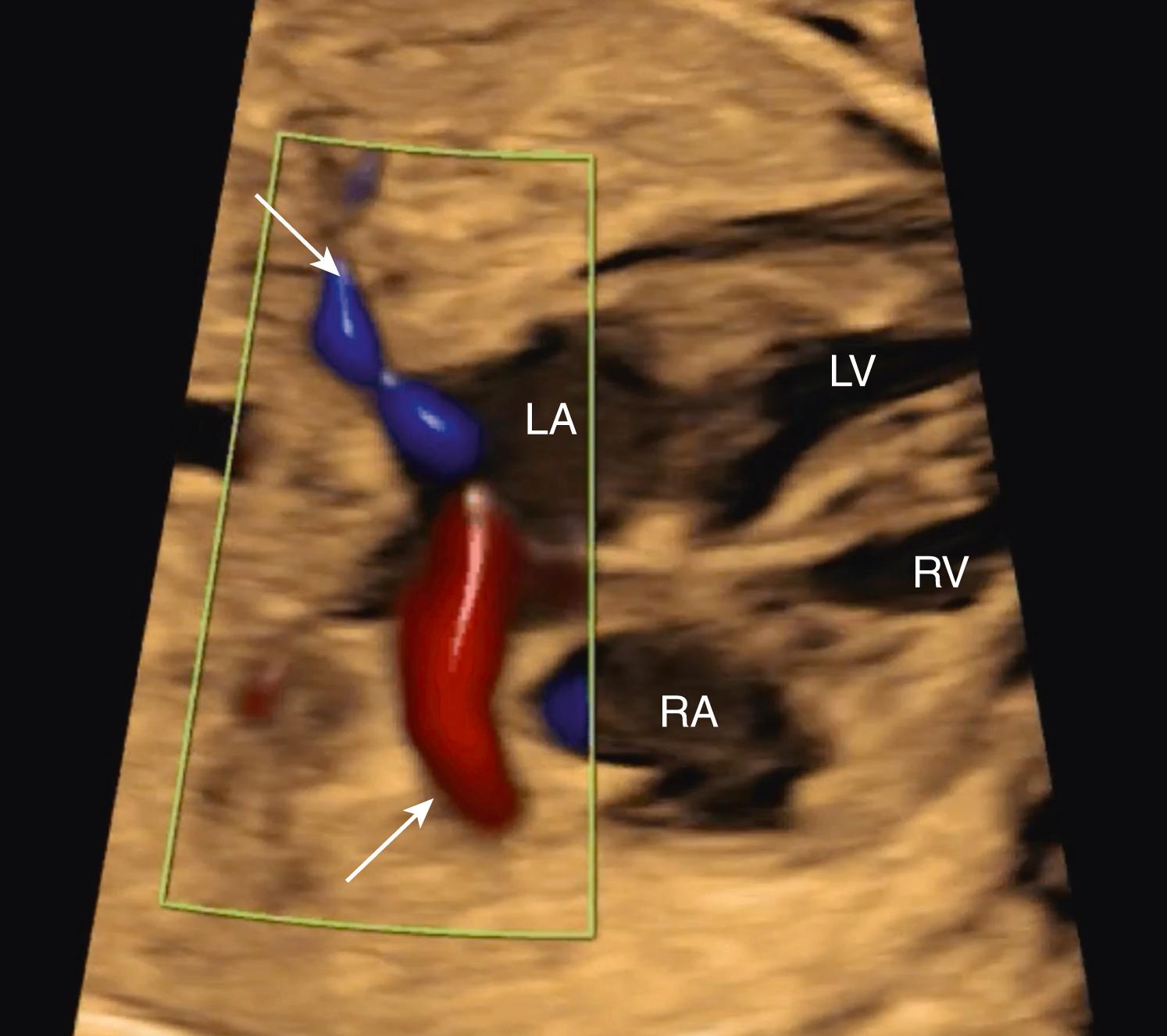 Figure 23.18, Fetal echocardiographic image of four-chamber view.