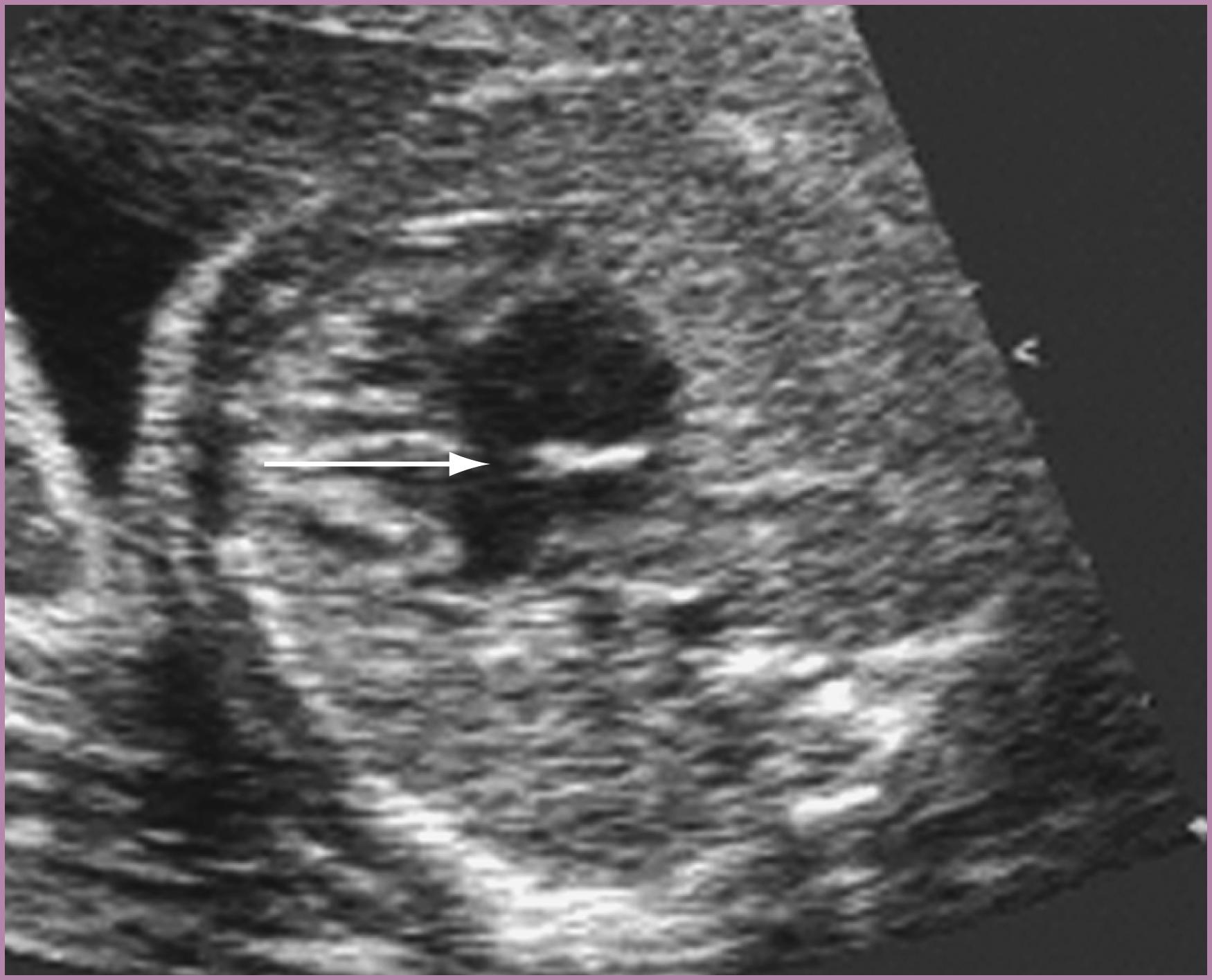 Figure 23.19, Fetal echocardiographic image of dilated coronary sinus, obtained with a slight inferior angulation from the four-chamber view.