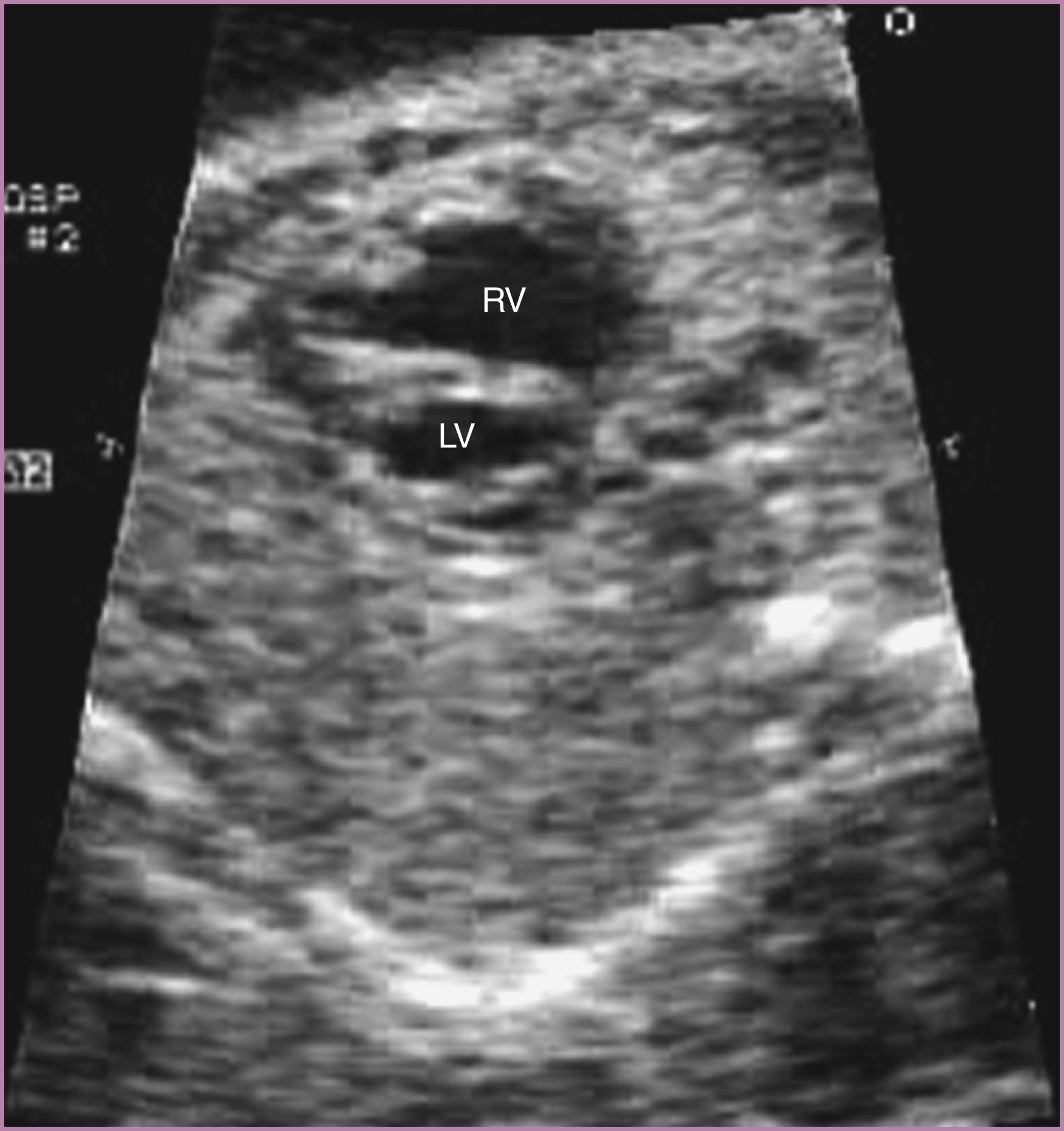 Figure 23.20, Fetal echocardiographic image of apical short-axis view.