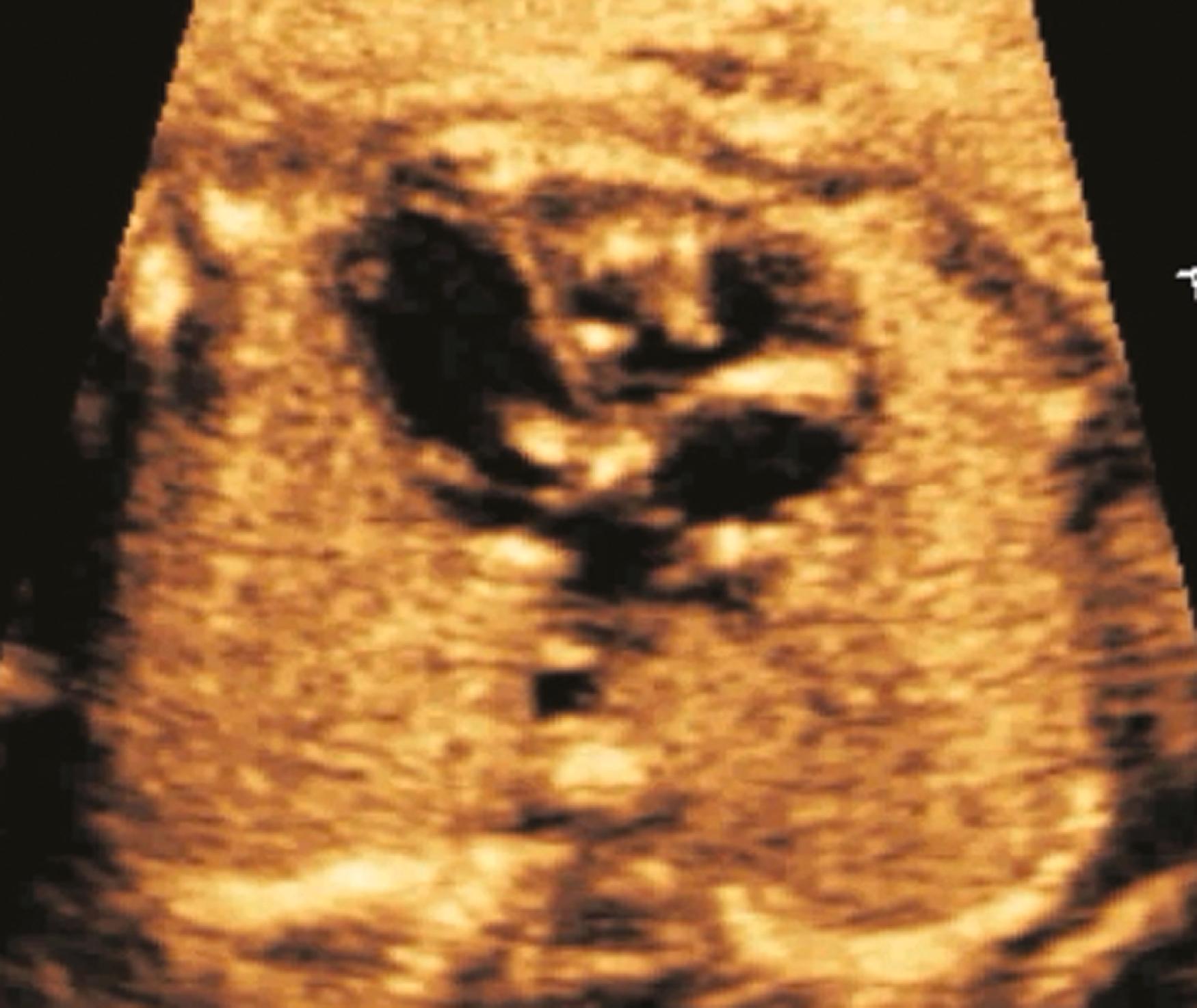 Figure 23.22, Fetal four-chamber view demonstrating multiple echogenic densities in the mitral and tricuspid valve grooves, as well as diffusely along the chordal apparatus of the tricuspid valve.