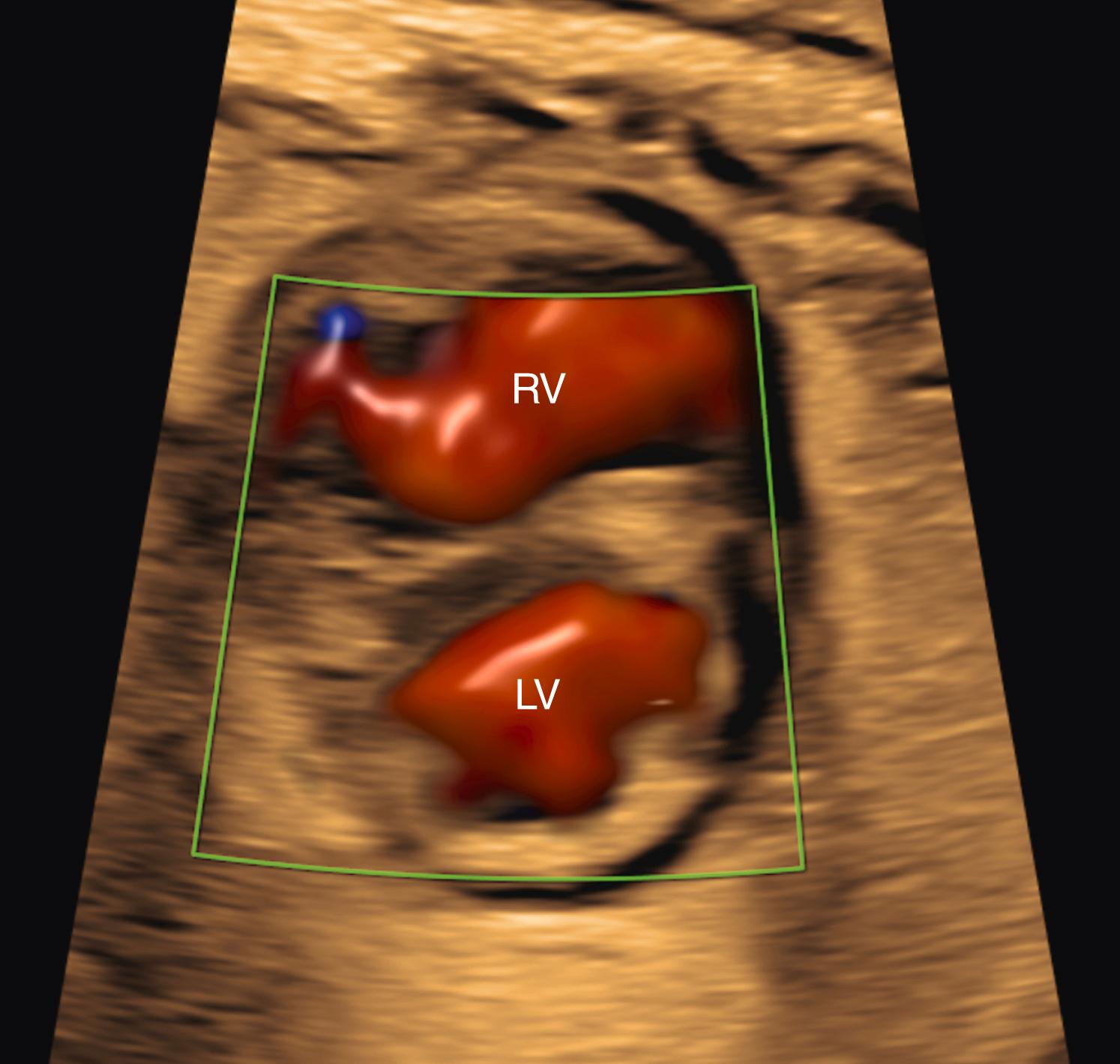 Figure 23.23, Fetal echocardiographic image of apical short-axis view.