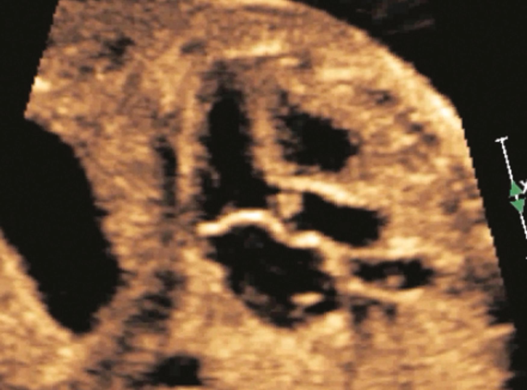 Figure 23.24, Oblique fetal echocardiographic image of left ventricular long-axis view demonstrating thickened aortic valve.