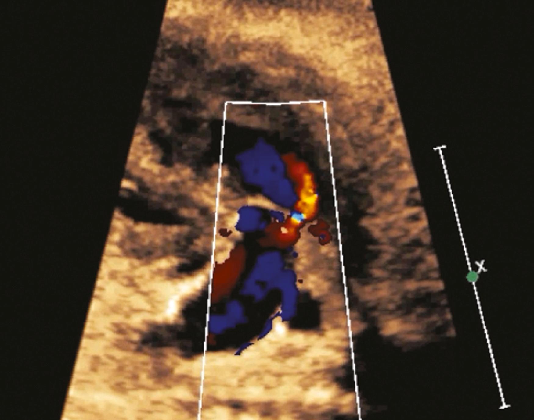 Figure 23.26, Fetal right ventricular outflow tract demonstrating pulmonary valve regurgitation during diastole (red jet).