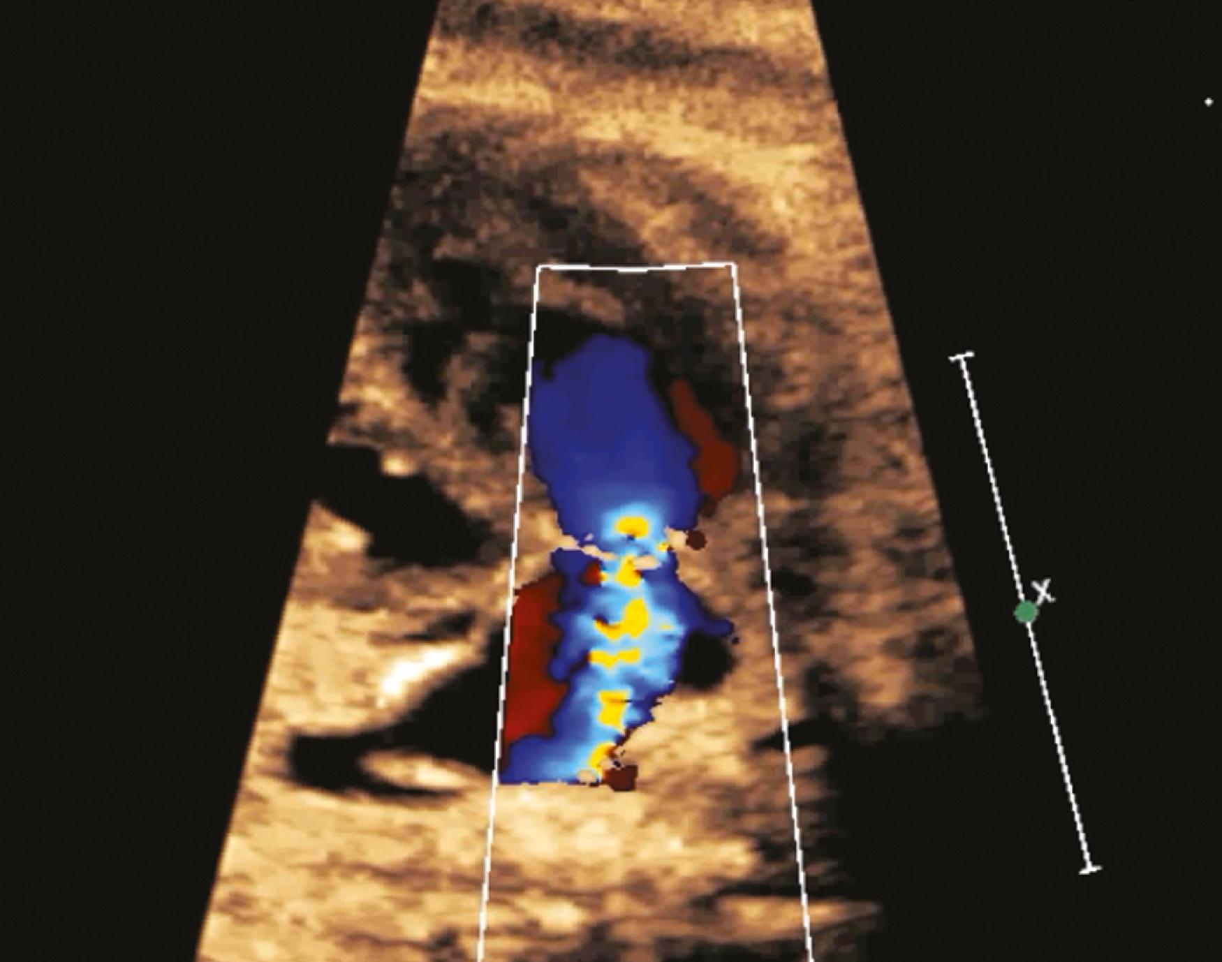 Figure 23.27, Fetal right ventricular outflow tract demonstrating turbulent flow across the pulmonary valve during systole.