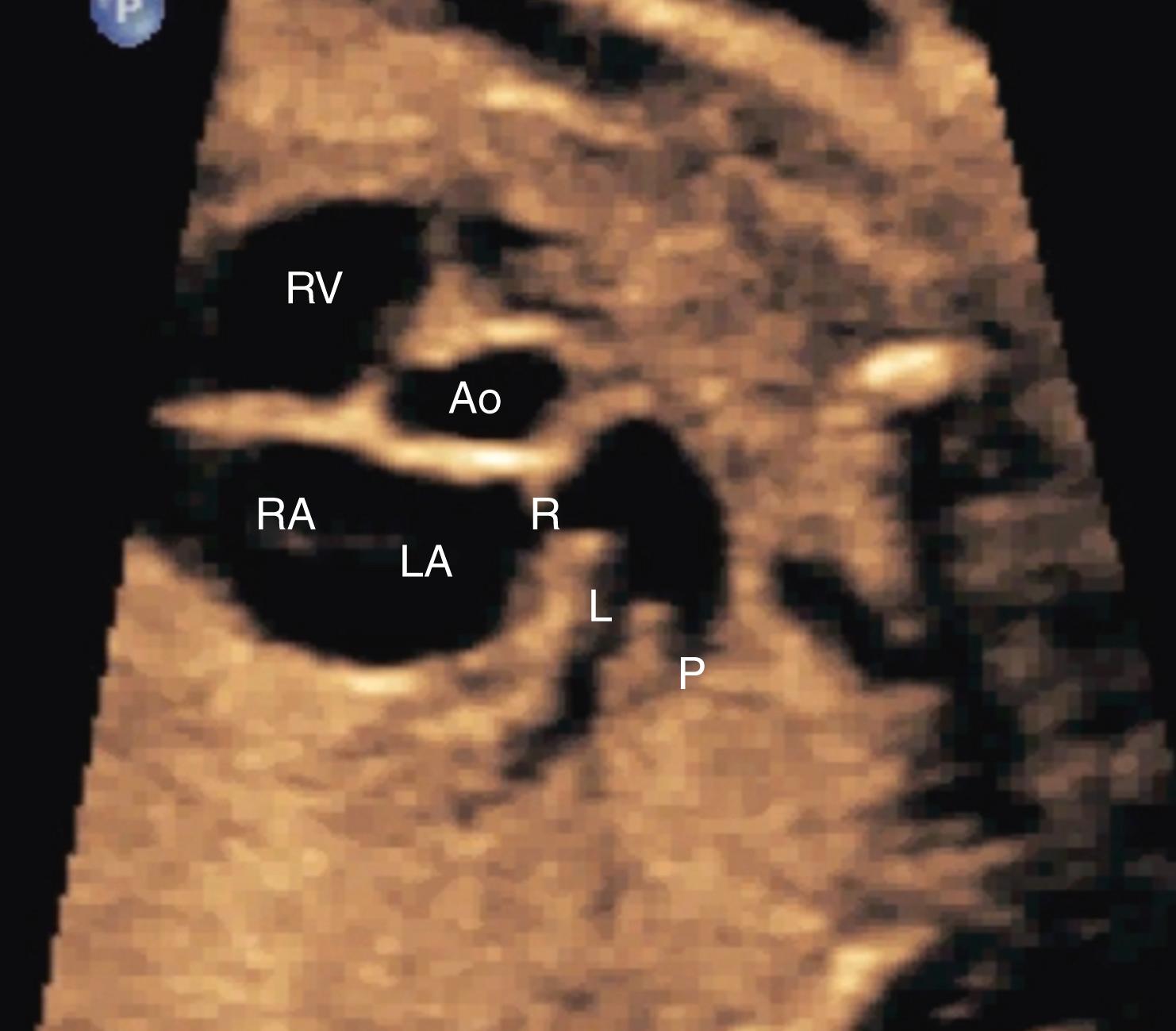 Figure 23.29, Fetal echocardiographic image of basal short-axis view during systole.