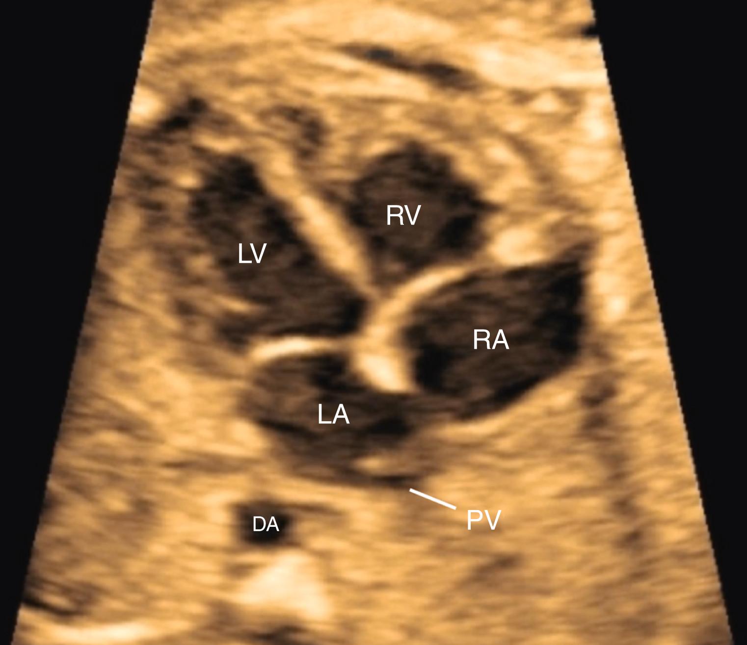 Figure 23.3, Fetal echocardiographic image of four-chamber view.