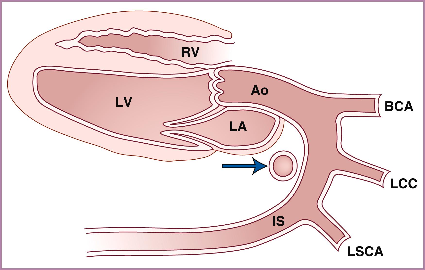 Figure 23.31, Schematic diagram of fetal aortic arch, sagittal view.