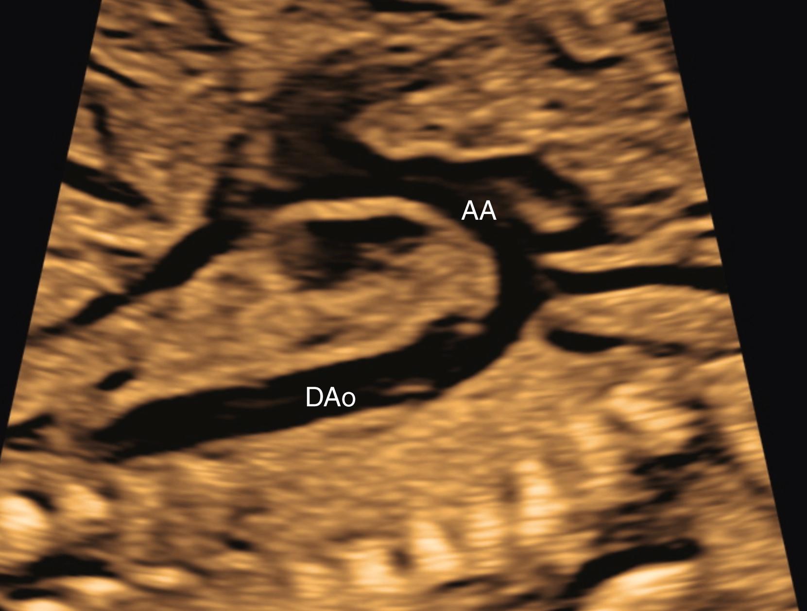 Figure 23.32, Echocardiographic image of fetal aortic arch, sagittal view.