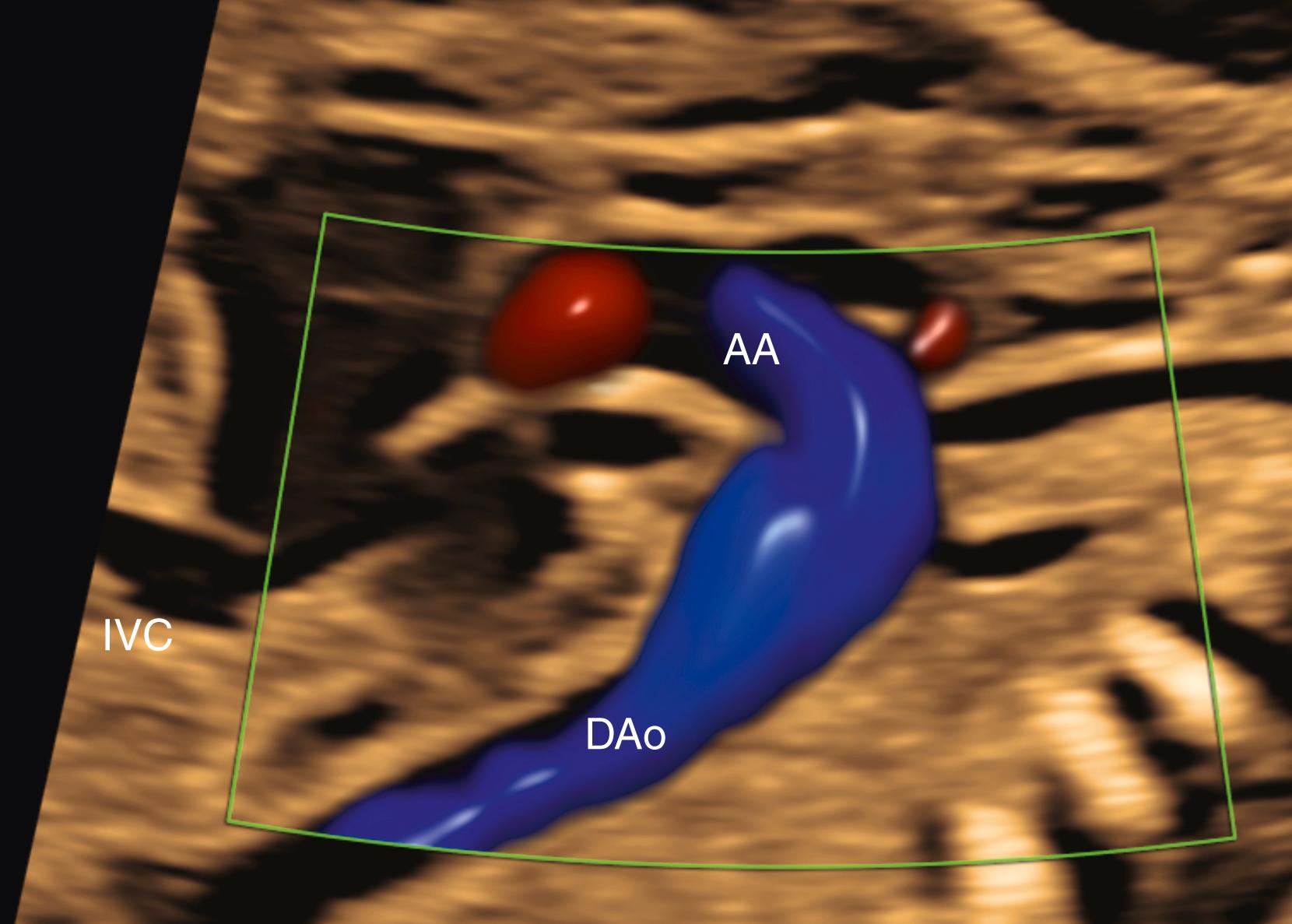 Figure 23.33, Echocardiographic image of fetal aortic arch, sagittal view.