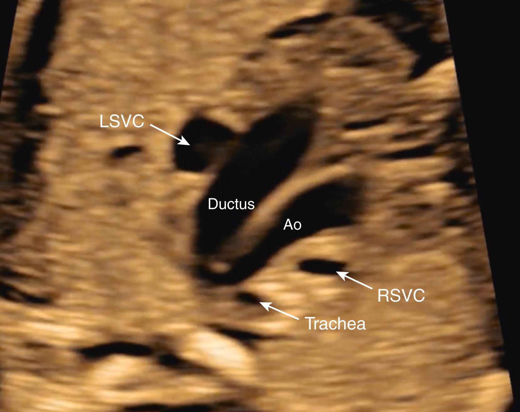 Figure 23.33.1, Echocardiographic image of three-vessel tracheal view.