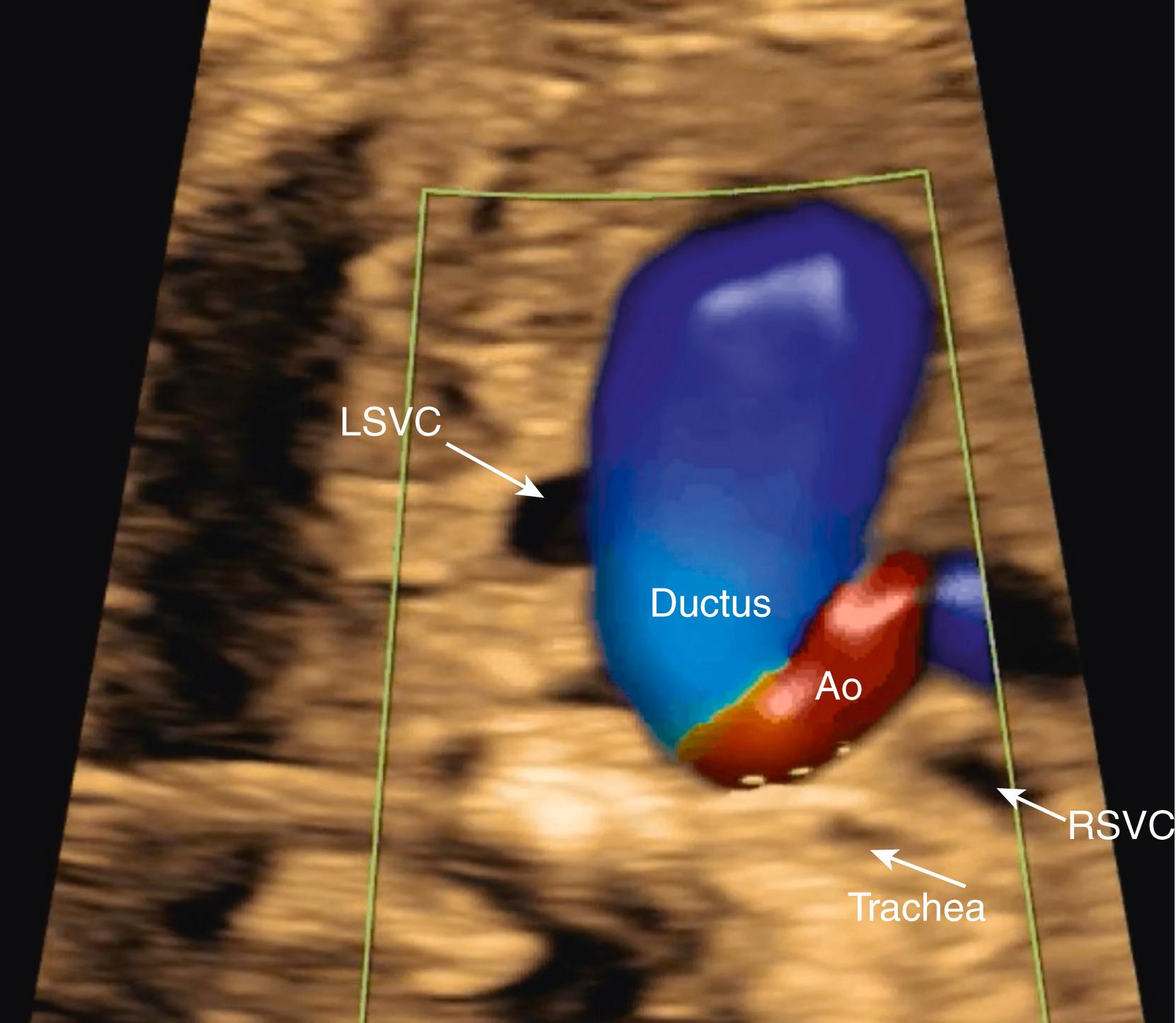 Figure 23.33.2, Echocardiographic image of three-vessel tracheal view.