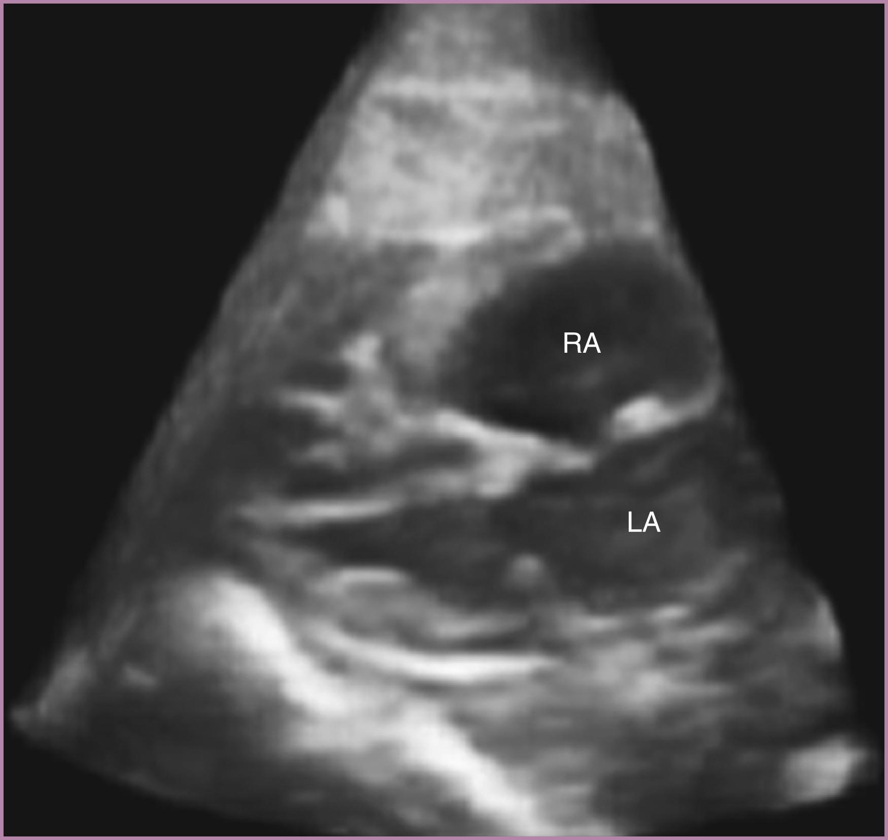 Figure 23.34, Fetal echocardiographic real-time three-dimensional rendered image of normal four-chamber view.
