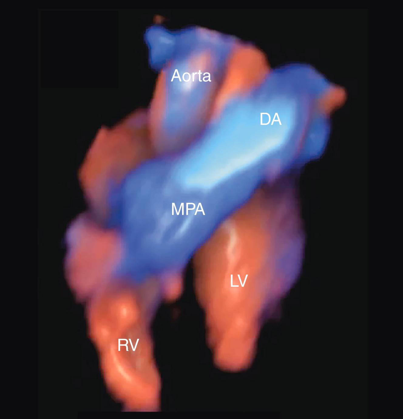 Figure 23.36, Fetal echocardiographic reconstructive three-dimensional rendered display.