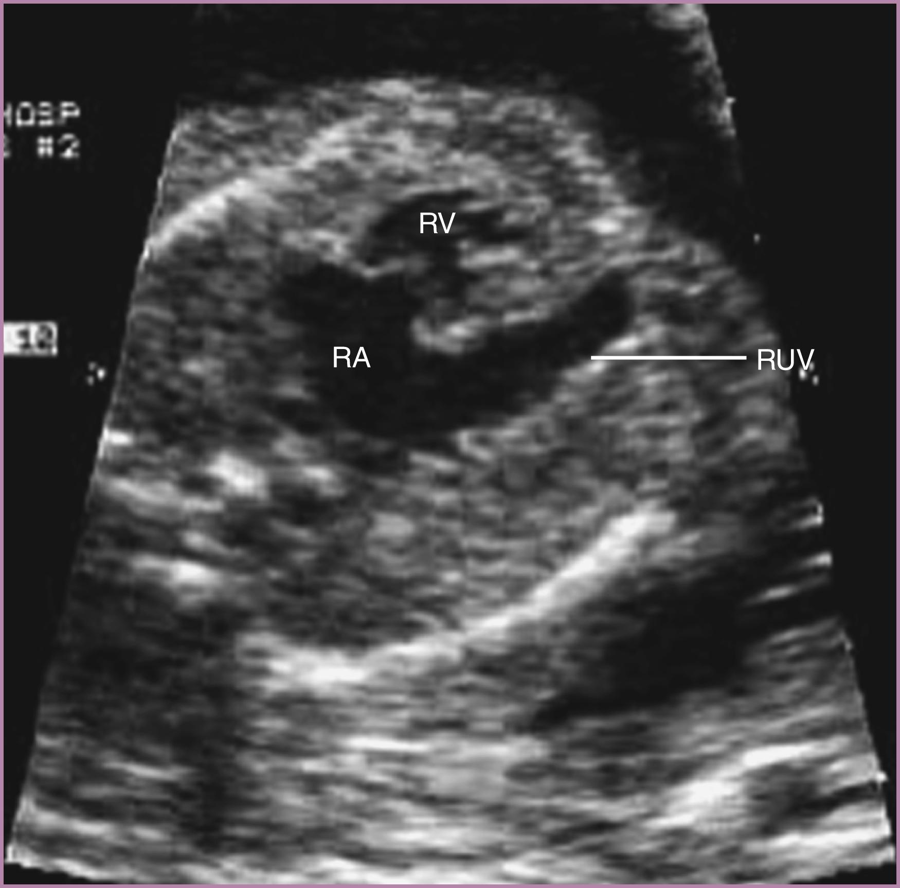 Figure 23.37, Fetal echocardiographic image of persistent right umbilical vein.