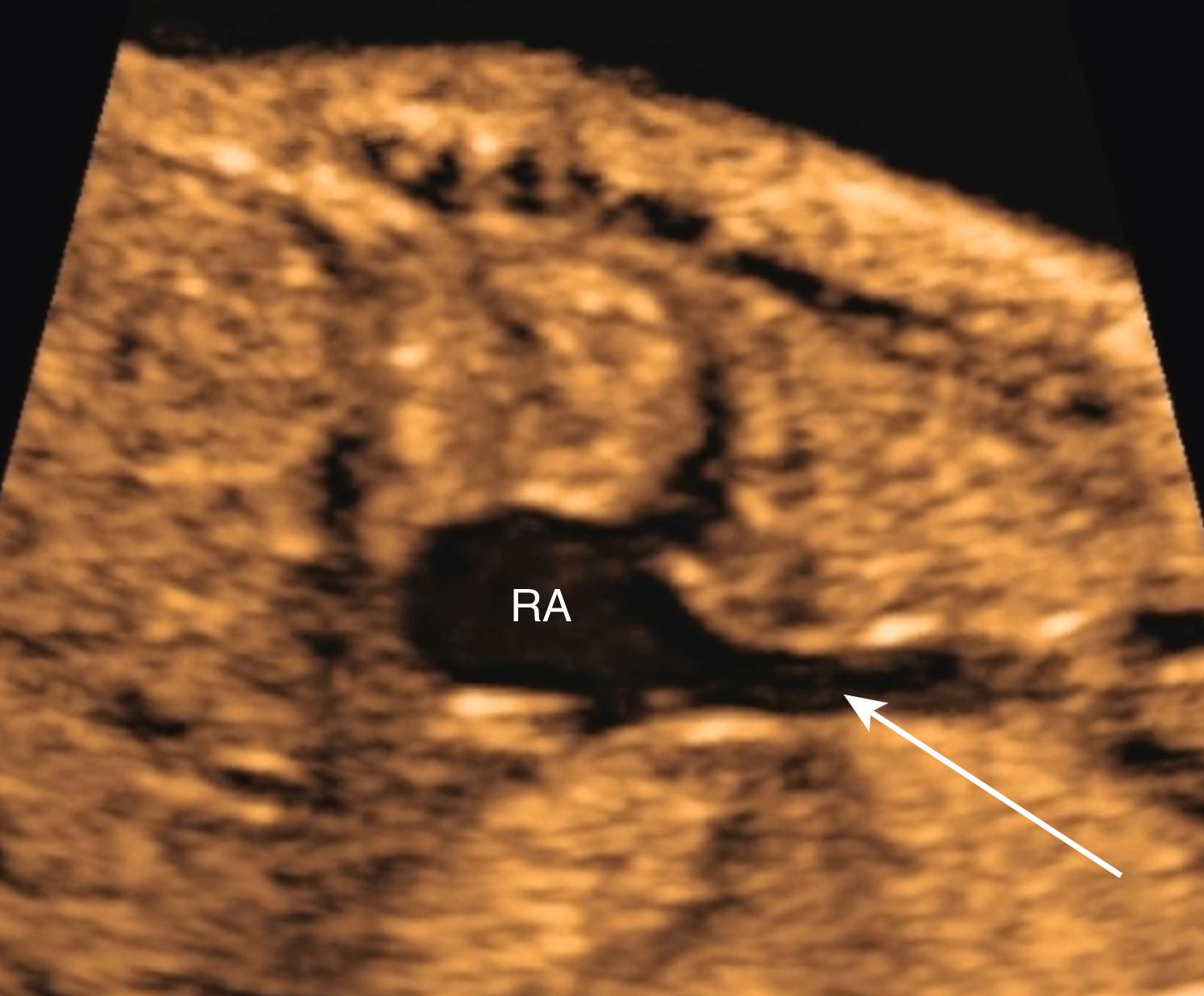 Figure 23.39, Fetal echocardiographic sagittal image of right-sided superior vena cava.