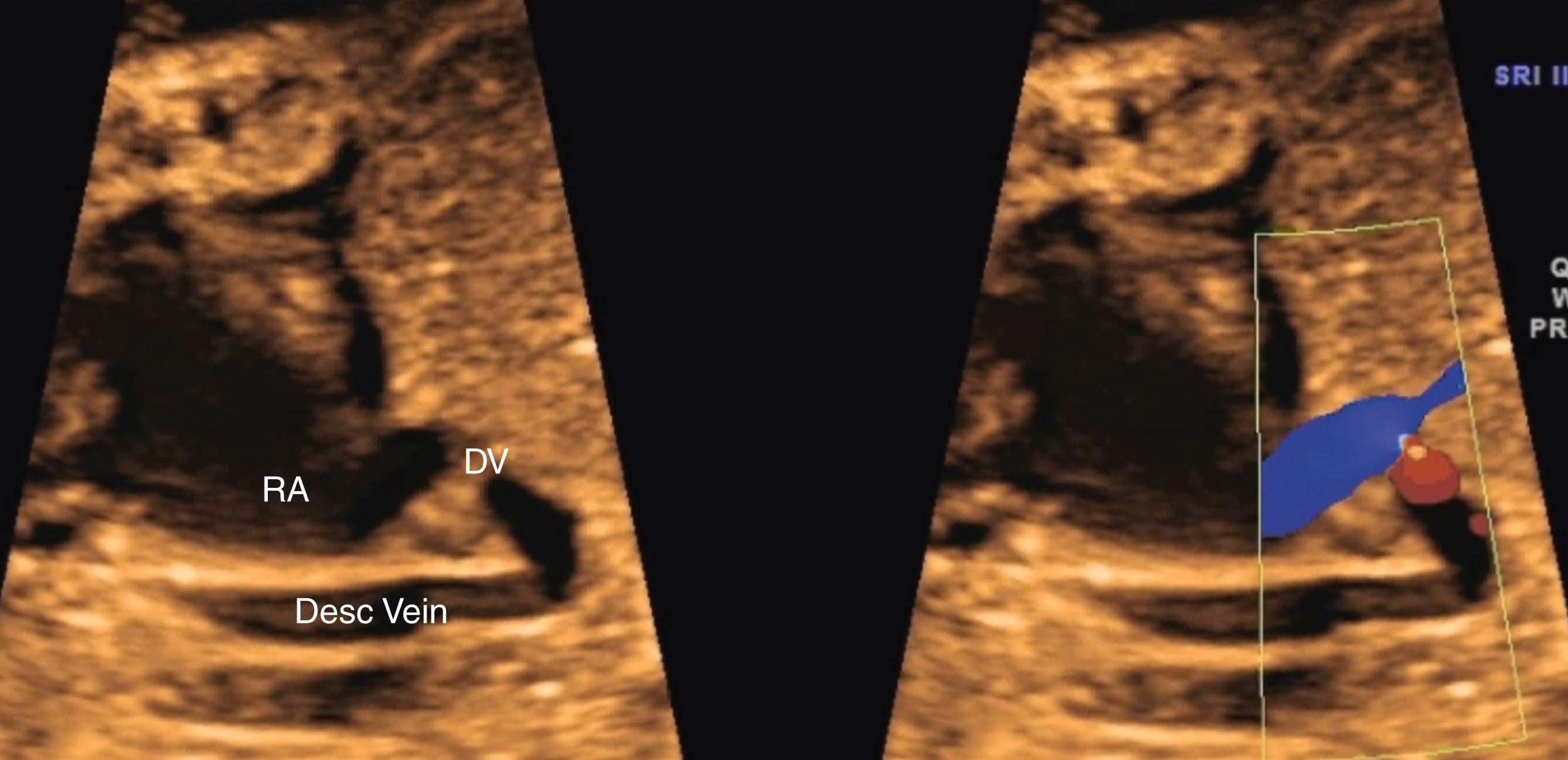 Figure 23.41, Fetal echocardiographic sagittal image of infradiaphragmatic total anomalous pulmonary venous return.