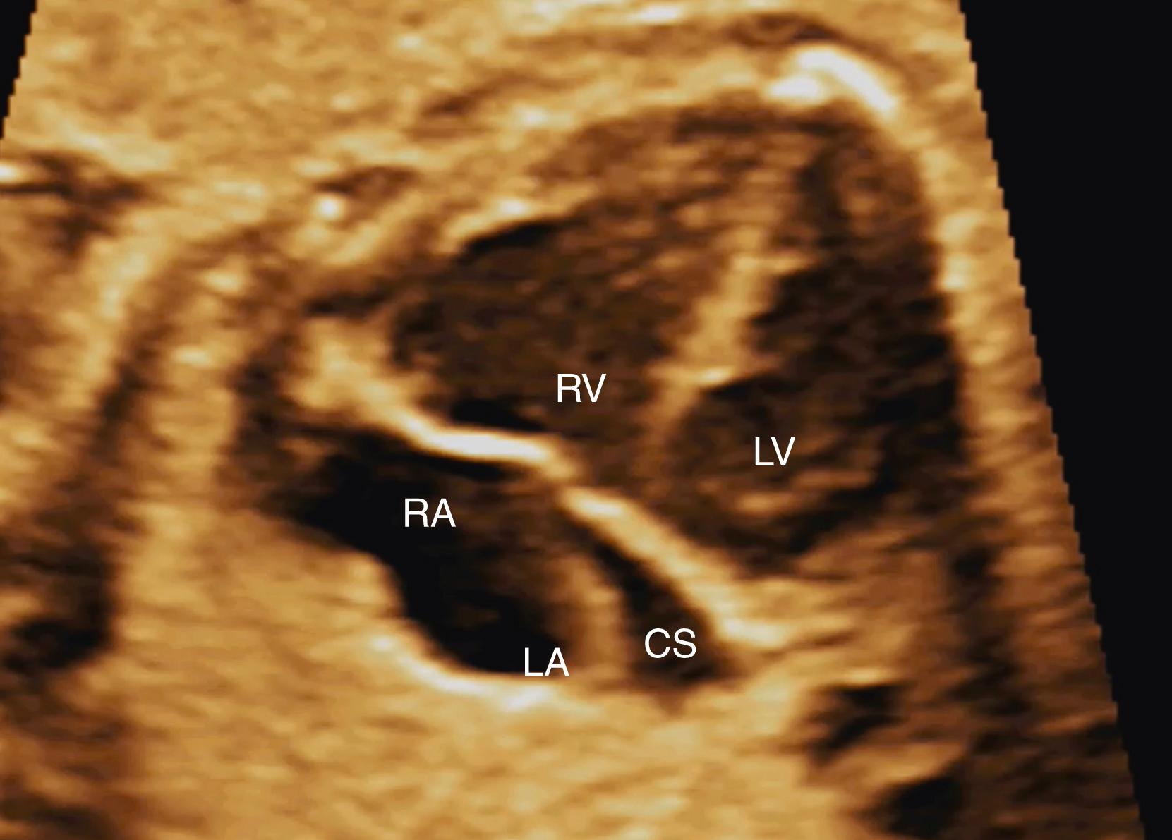 Figure 23.42, Fetal echocardiographic four-chamber view image of total anomalous pulmonary venous return to the coronary sinus.