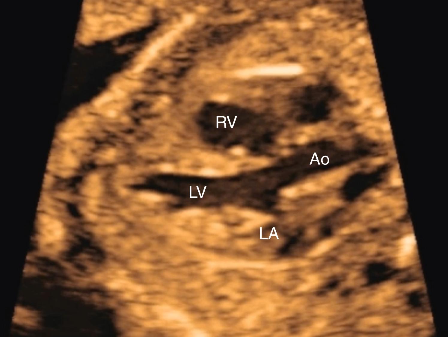 Figure 23.5, Fetal echocardiographic image of left ventricular long-axis view.