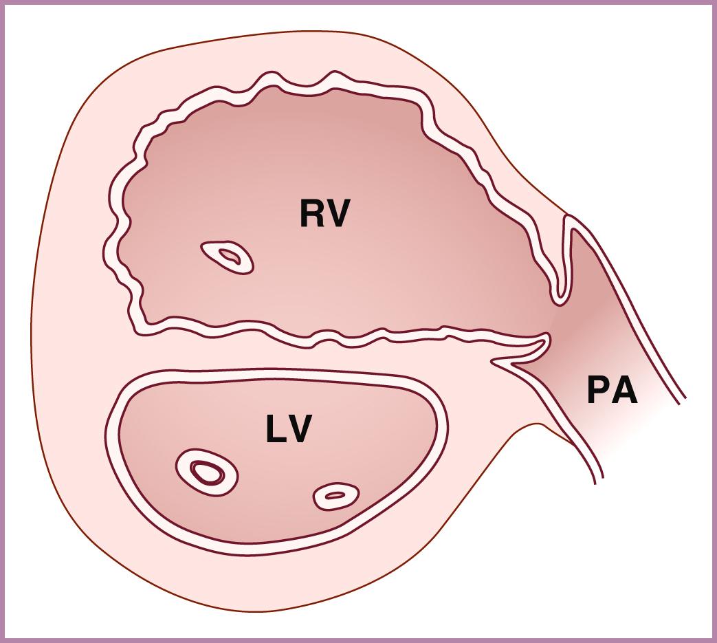 Figure 23.6, Schematic diagram of right ventricular outflow tract crossing view.