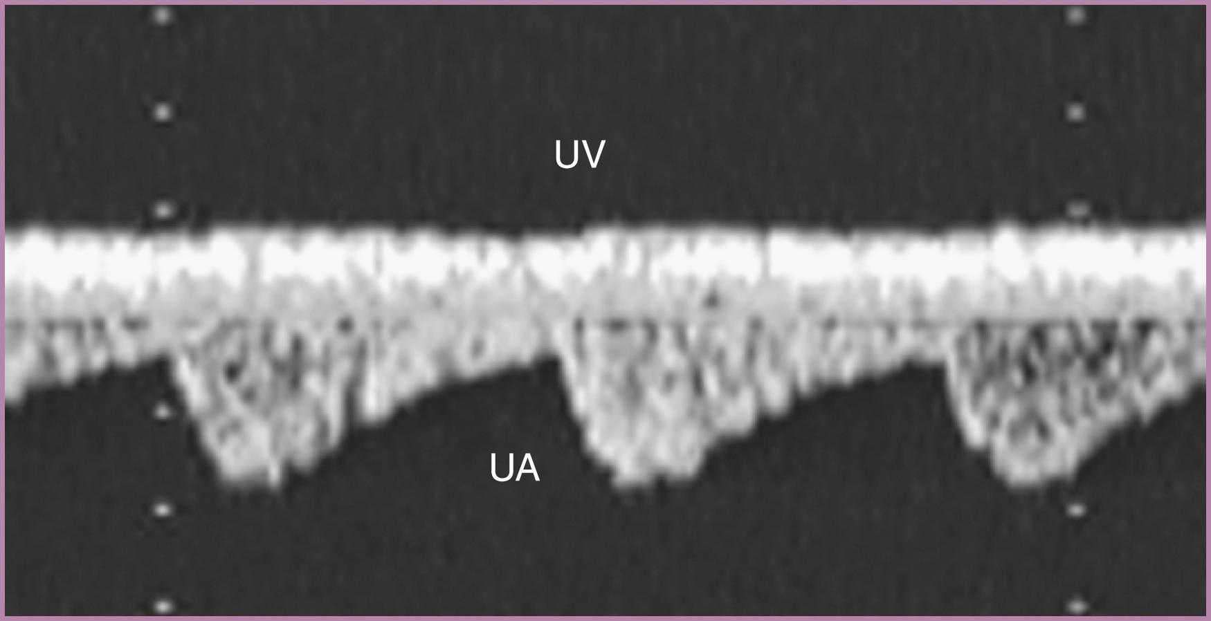 Figure 23.8, Spectral Doppler display of flow in a free-floating umbilical cord.