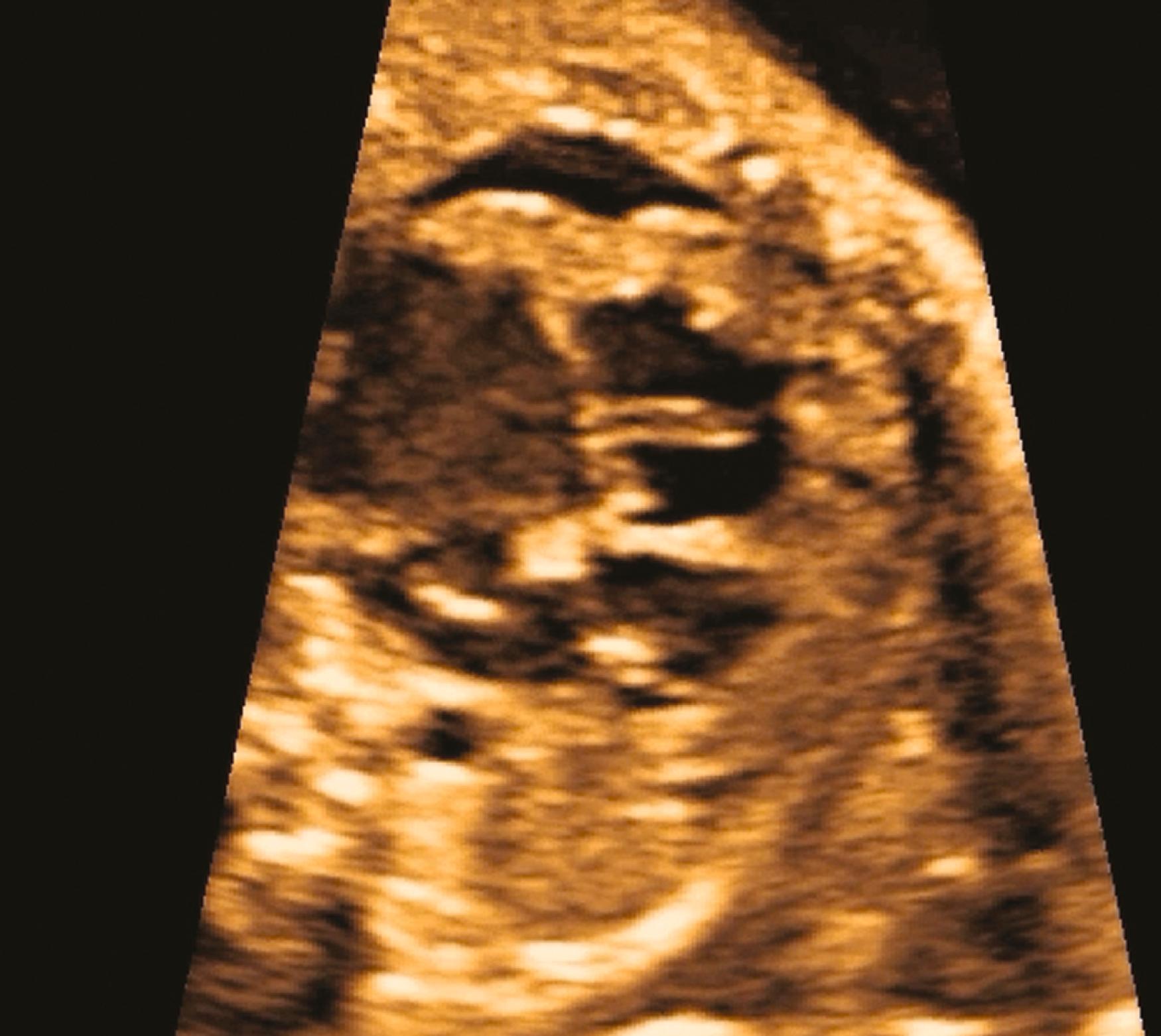 Figure 23.9, Fetal echocardiographic image of loculated pericardial effusion (anterior to tricuspid valve atrioventricular groove and adjacent to the right ventricular free wall).