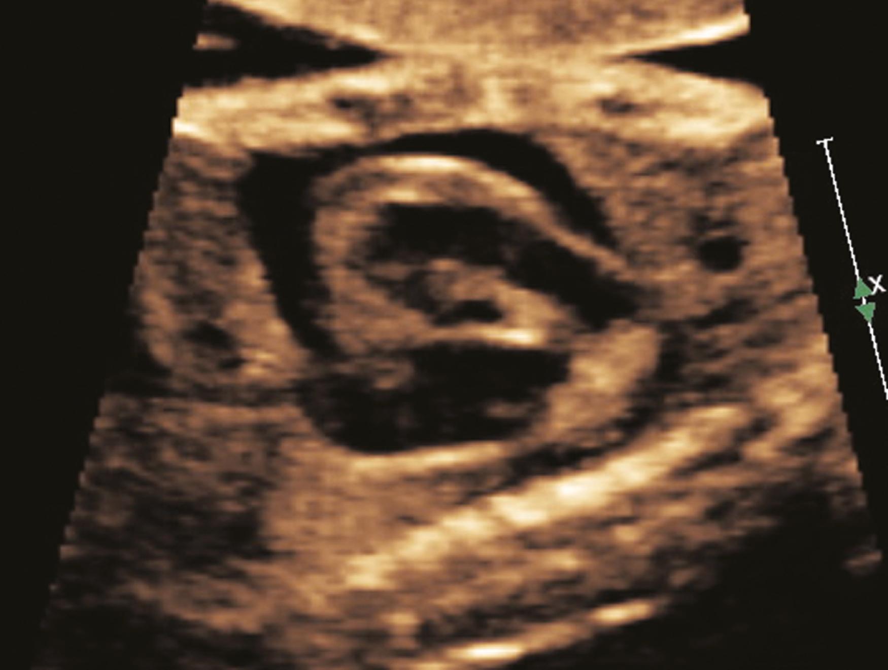 Figure 23.10, Fetal echocardiographic sagittal image of circumferential pericardial effusion.