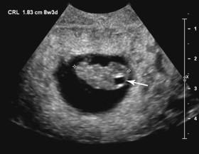 F igure 15-1, Rhombencephalon. Longitudinal image of the embryo at 8 weeks 3 days shows a cystic space (arrow) normally seen in the posterior portion of the head during embryologic development of the rhombencephalon.