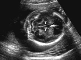 F igure 15-11, Dilated third ventricle. Axial image of the fetal head shows mildly dilated third ventricle (arrow) between the thalami (T).