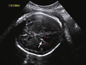 F igure 15-12, Mild ventriculomegaly: aneuploidy. Axial image of the fetal head shows mild ventriculomegaly with dangling choroid plexus (arrow) and ventricular width (red cursors) of 1.06 cm. Amniocentesis revealed trisomy 21.