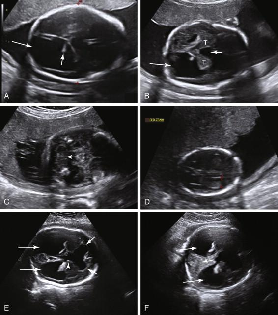 F igure 15-13, Aqueductal stenosis. Ultrasound images in two fetuses with aqueductal stenosis. A to C, Fetus with severe hydrocephalus, first imaged in the late second trimester. A, Markedly dilated lateral ventricle (long arrow) with dangling, diminutive choroid plexus (short arrow) . B, Markedly dilated third ventricle (short arrow) causing splaying of the thalami (T). Lateral ventricle is again shown to be markedly enlarged (long arrow). C, No evidence of dilated fourth ventricle in the expected location in the anterior portion of the posterior fossa (arrow) . D to F, Fetus with normal ventricles initially. D, Axial image of the head at 18 weeks shows a normal-appearing lateral ventricle measuring 0.73 cm (red cursors). E and F, Follow-up ultrasound of the fetus in image D at 34 weeks. E, Marked ventriculomegaly with dilatation of the frontal horns (short arrows) , occipital horns (long arrows), and third ventricle (arrowhead). F, No evidence of dilated fourth ventricle in the expected location in the anterior portion of the posterior fossa (short arrow) . Dilated lateral ventricles again seen (long arrows).