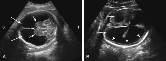 F igure 15-14, Hydranencephaly versus severe hydrocephalus. A, Hydranencephaly. Coronal image of the fetal head at 28 weeks gestation demonstrates a large, fluid-filled cavity (long arrows) superior to the thalami (short arrows) . Note the absence of a peripheral rim of cortical tissue, helping distinguish hydranencephaly from severe hydrocephalus. Also note identification of the falx cerebri (arrowhead) , helping distinguish hydranencephaly from alobar holoprosencephaly. B, Severe hydrocephalus. Axial image of the head of a different fetus at 29 weeks gestation depicts severe hydrocephalus due to aqueductal stenosis, with markedly dilated lateral ventricles (long arrows) , and thin peripheral rim of maintained cortical tissue (arrowheads) . I, Inferior; S, superior.